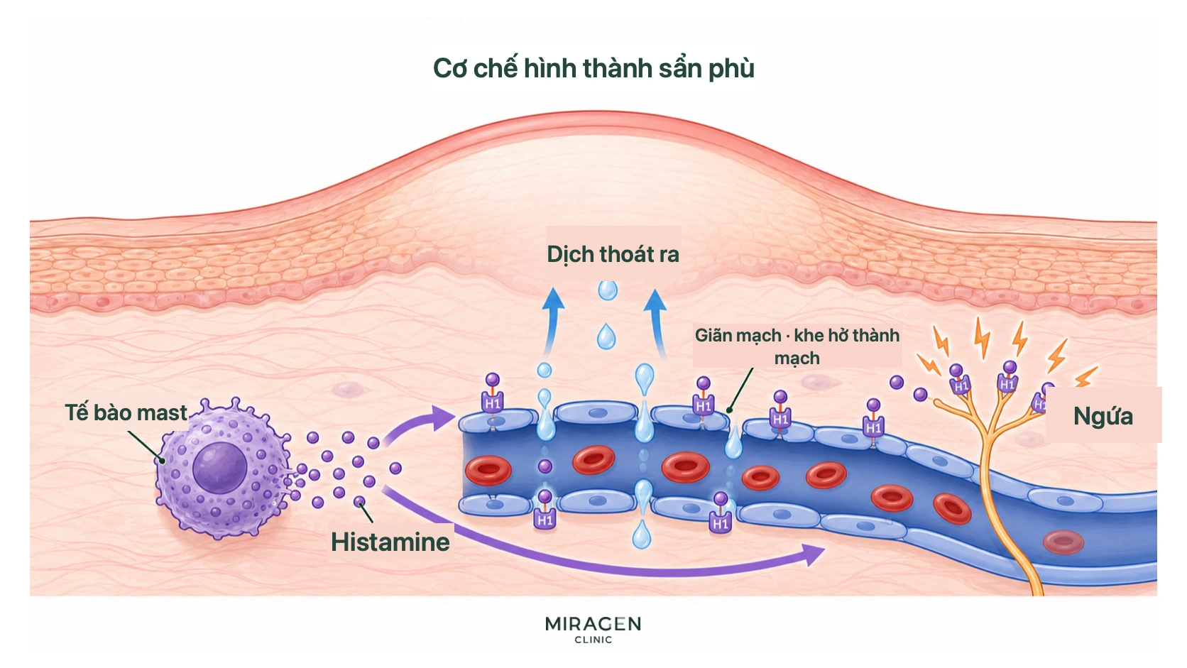 Sơ đồ histamin từ tế bào mast gắn vào thụ thể H1 của mạch máu và dây thần kinh, làm nước thoát qua thành mạch gây sẩn phù và ngứa