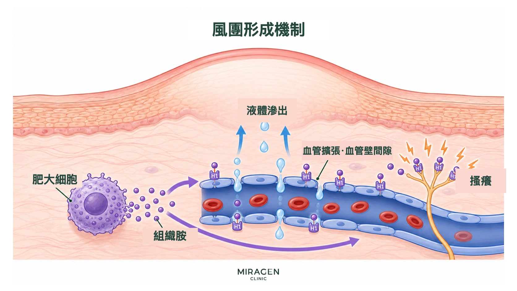 示意圖:肥大細胞釋放的組織胺與血管和感覺神經上的 H1 受體結合,水分從血管壁間隙流出,引起風團和搔癢