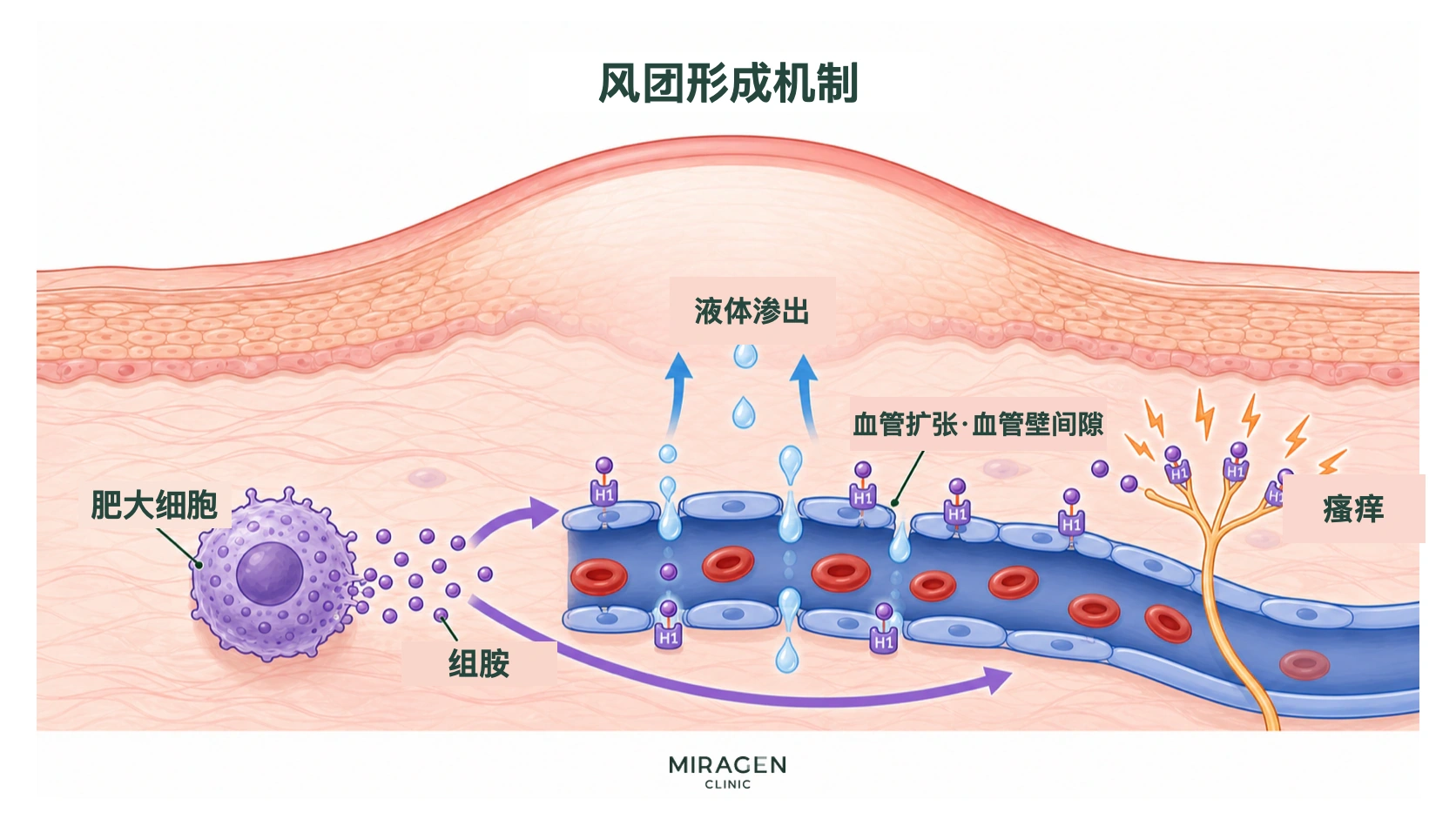 示意图：肥大细胞释放的组胺与血管和感觉神经上的 H1 受体结合，水分从血管壁间隙流出，引起风团和瘙痒