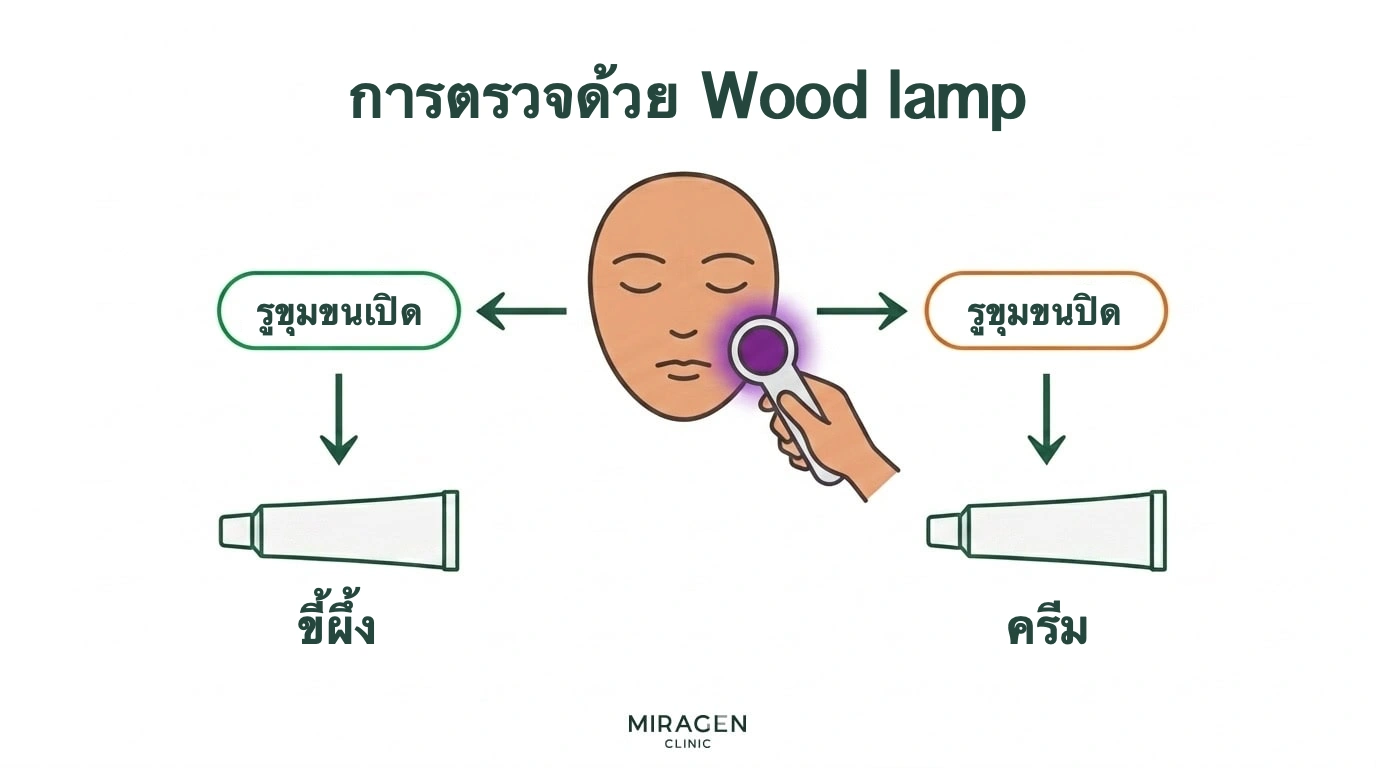 ผังการเลือกยาทาผื่นภูมิแพ้ผิวหนังบนใบหน้าหลังตรวจรูขุมขนด้วยแสงวูด: เลือกยาขี้ผึ้งเมื่อรูขุมขนเปิด และครีมเมื่อรูขุมขนอุดตัน