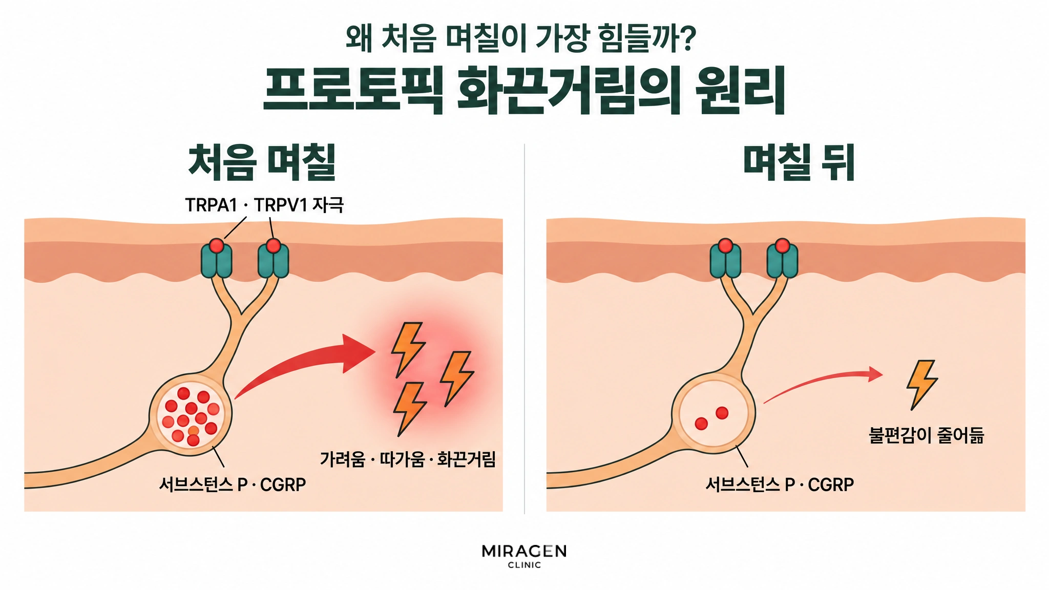 처음 며칠에는 TRPA1 · TRPV1이 자극되어 신경 주머니에 가득 찬 서브스턴스 P와 CGRP가 나와 가려움 · 따가움 · 화끈거림이 생기고, 며칠 뒤에는 주머니가 거의 비어 불편감이 줄어드는 것을 두 칸으로 비교한 그림