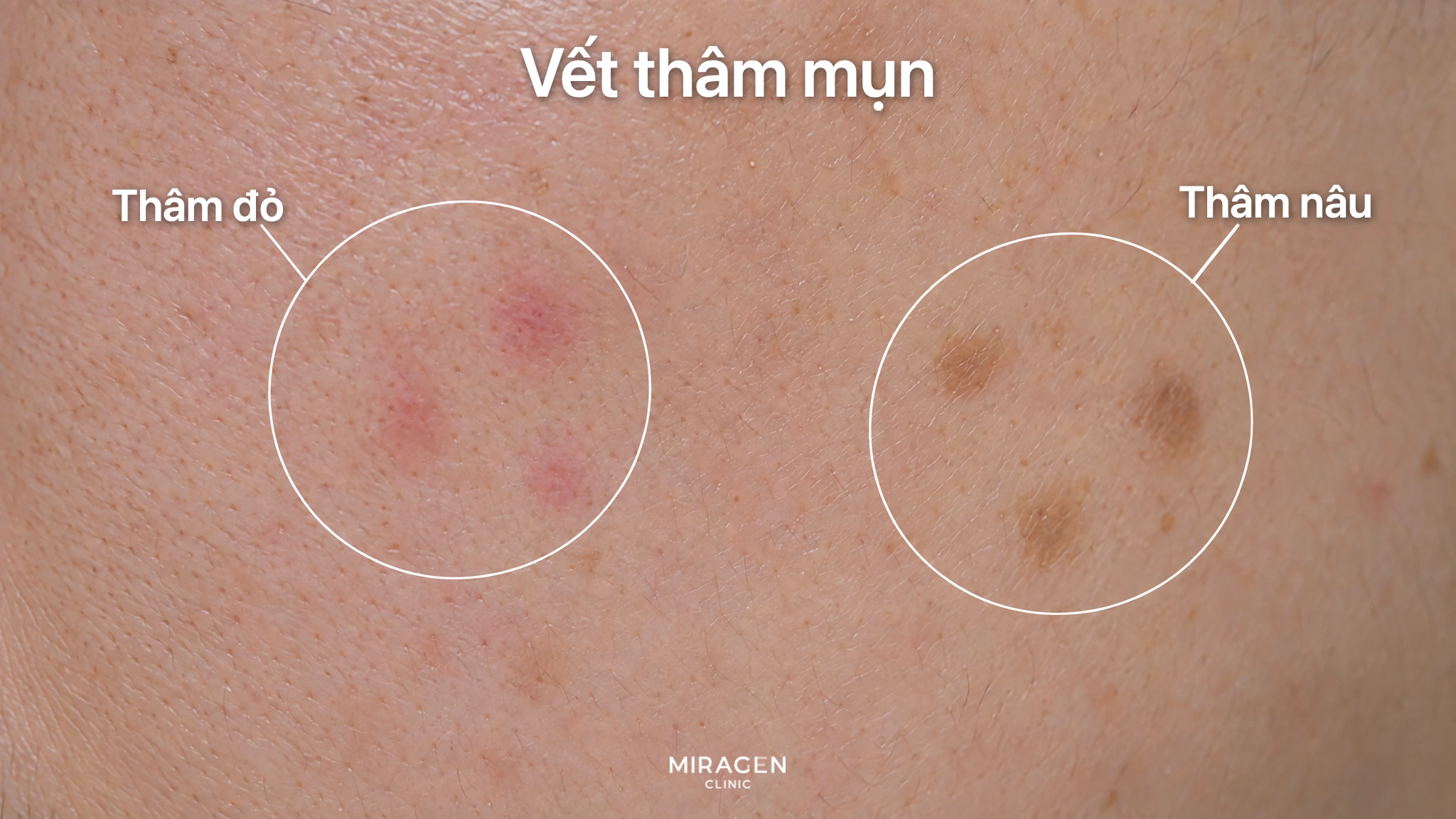 Hình phóng to da má, khoanh tròn vết đỏ và vết nâu phẳng