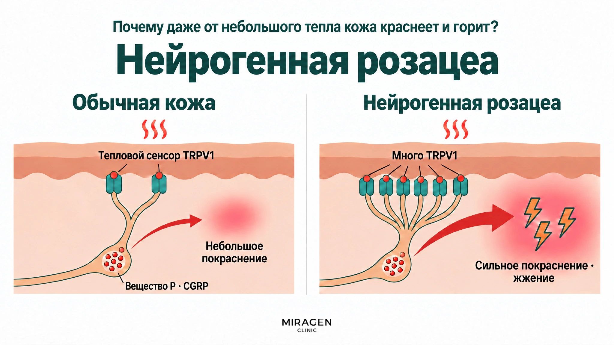 Сравнение в двух частях: количество вещества P · CGRP в нервном мешочке примерно одинаково, но при том же тепловом раздражении у обычной кожи мало TRPV1, выделяется немного и кожа слегка краснеет, а при нейрогенной розацеа TRPV1 много, выделяется гораздо больше и возникают сильное покраснение и жжение