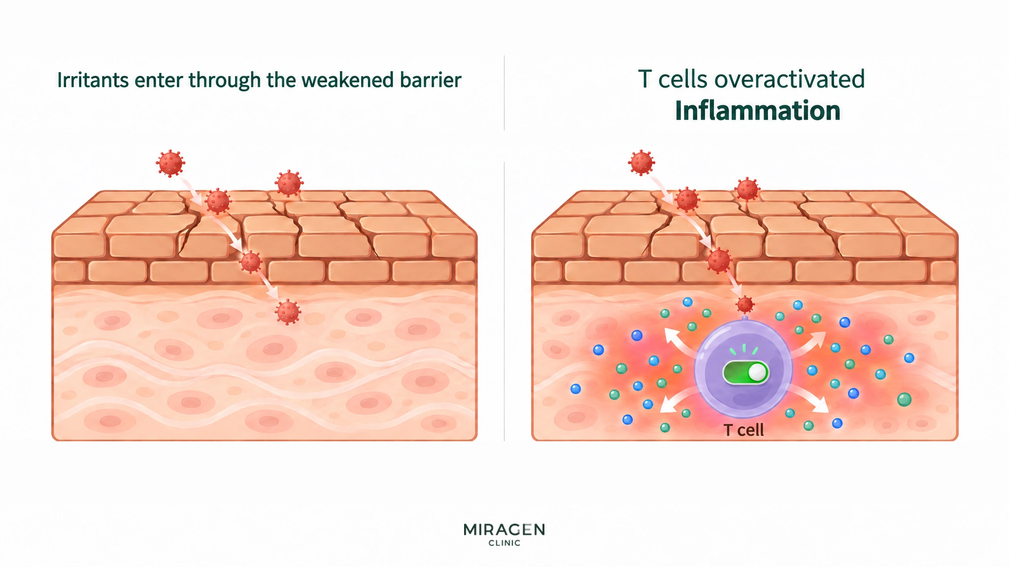 A two-panel illustration: irritants enter through a cracked skin barrier, the switch of a T cell in the skin turns on, and inflammatory substances spread and cause redness