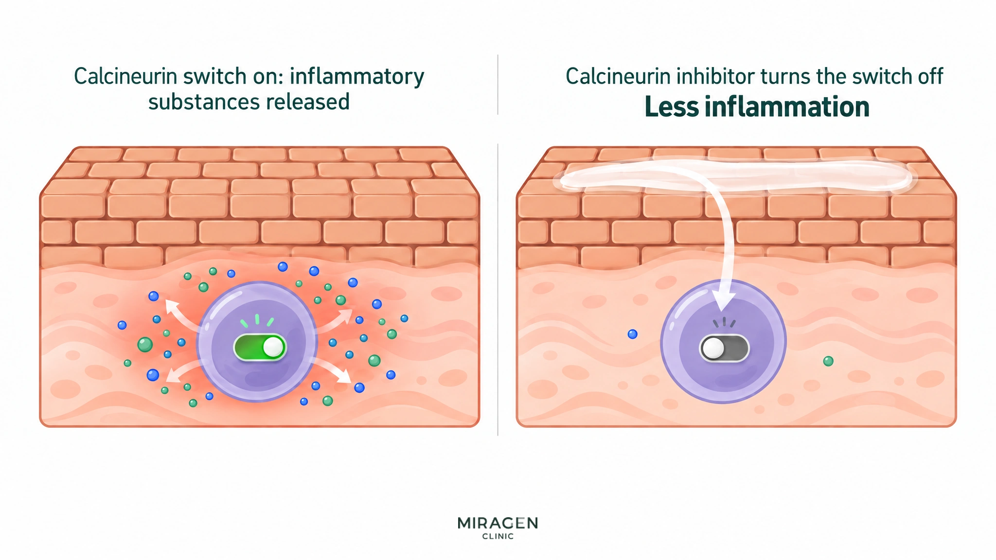 A comparison illustration: with the calcineurin switch on, a T cell releases inflammatory substances; a calcineurin inhibitor applied to the skin turns that switch off and inflammation decreases