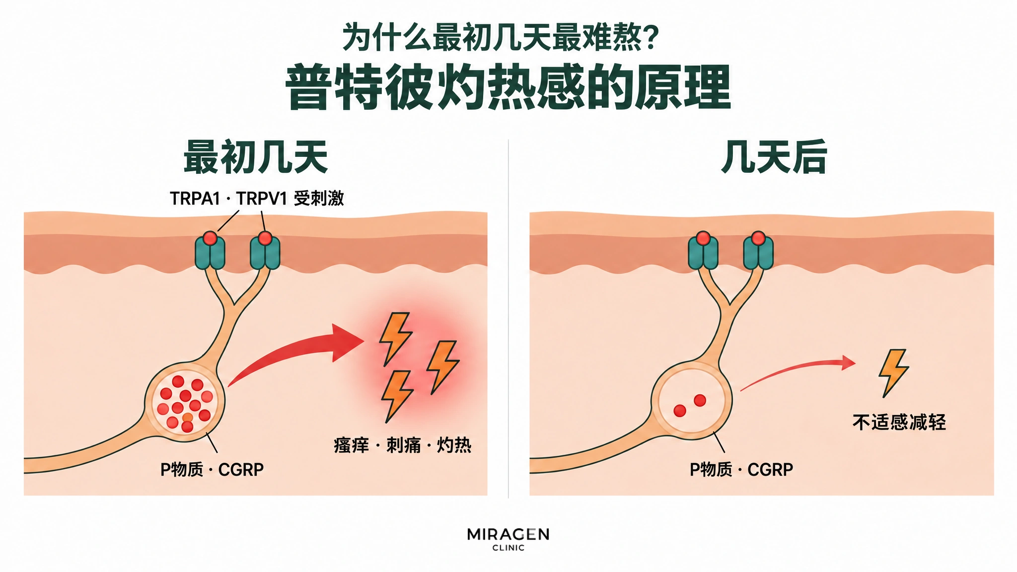 分两栏对比的示意图:最初几天 TRPA1 · TRPV1 受到刺激,神经囊袋中积满的 P物质和 CGRP 释放出来,引起瘙痒 · 刺痛 · 灼热;几天后囊袋几乎排空,不适感减轻