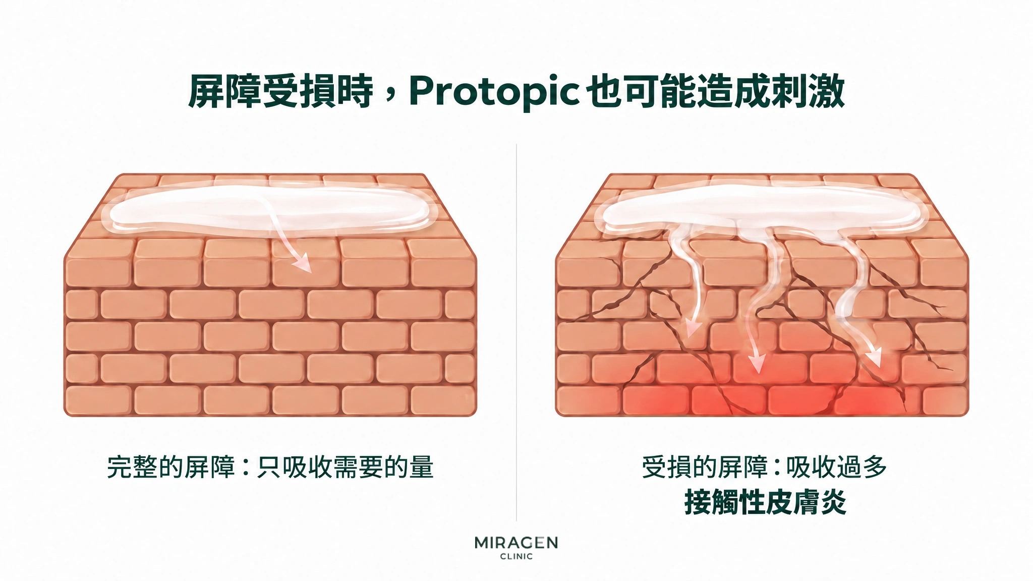 以左右兩格比較:完整的磚牆屏障只會滲入少量藥膏;有裂痕的屏障,藥膏會沿著裂縫深深滲入,底下發紅發熱