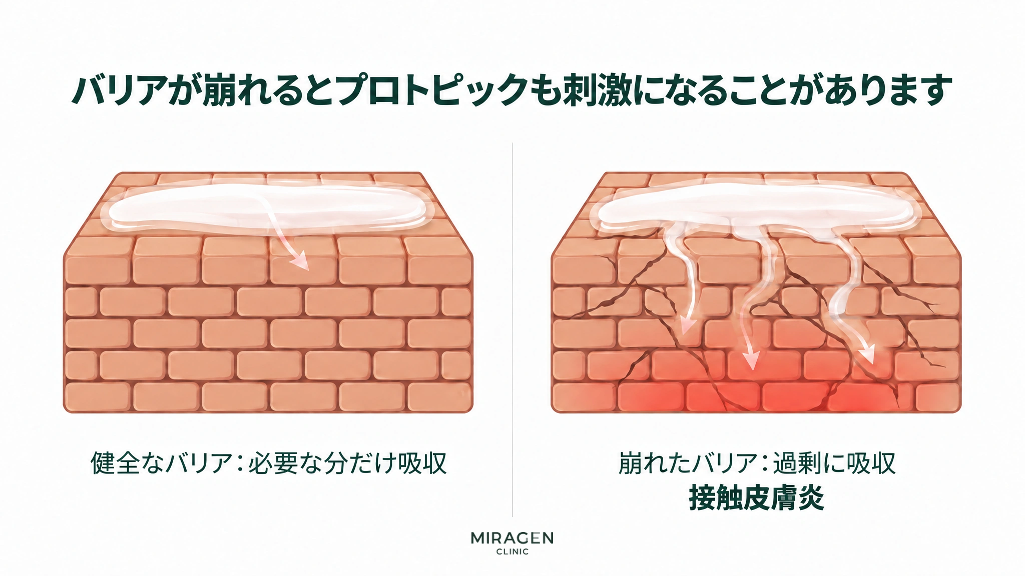 健全なレンガ塀のバリアには軟膏が少ししか染み込まず、ひびの入ったバリアには軟膏が亀裂に沿って深く染み込み、下が赤く熱を帯びる様子を2コマで比べた図