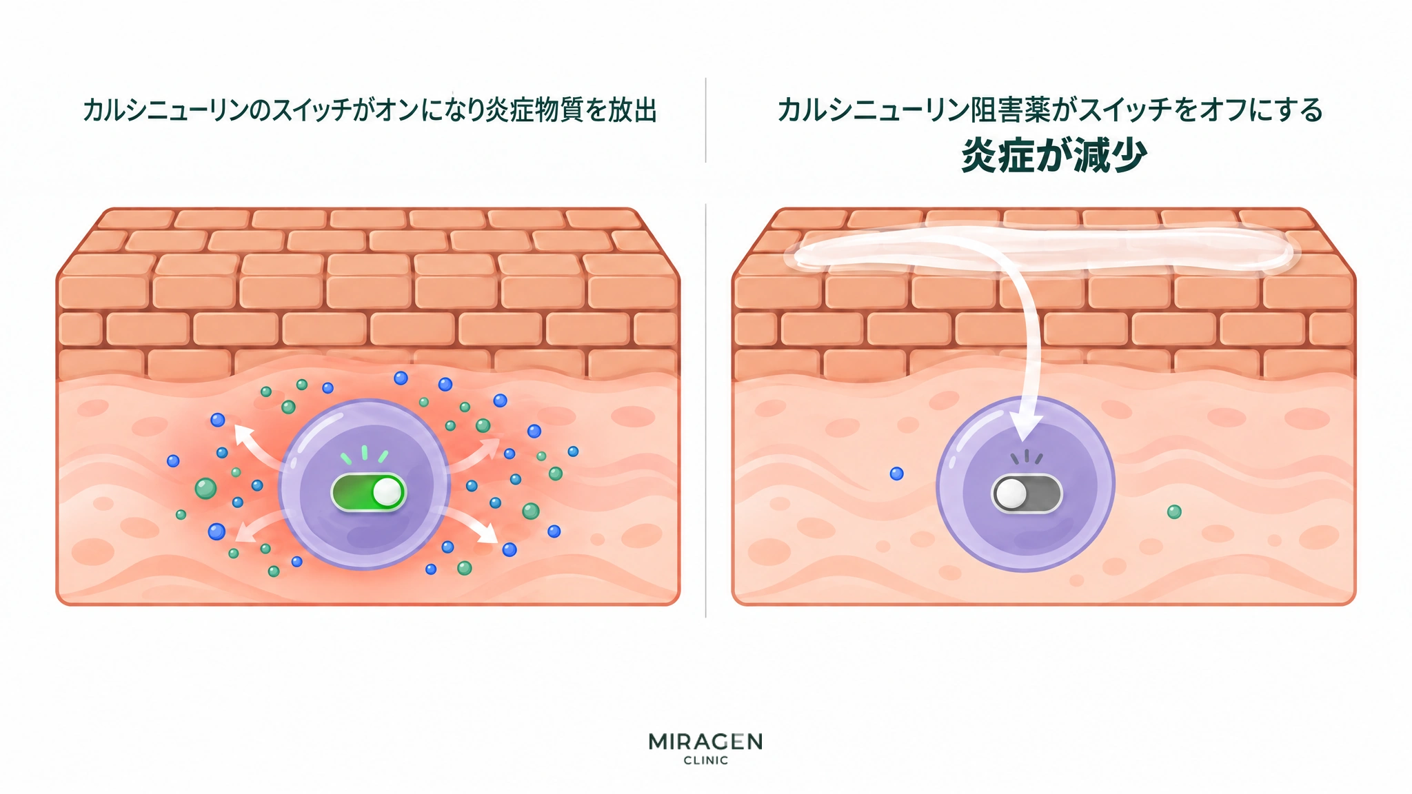 オンになったカルシニューリンのスイッチによってT細胞が炎症物質を放出する様子と、皮膚に塗ったカルシニューリン阻害薬がそのスイッチをオフにして炎症が減った様子を比べた図