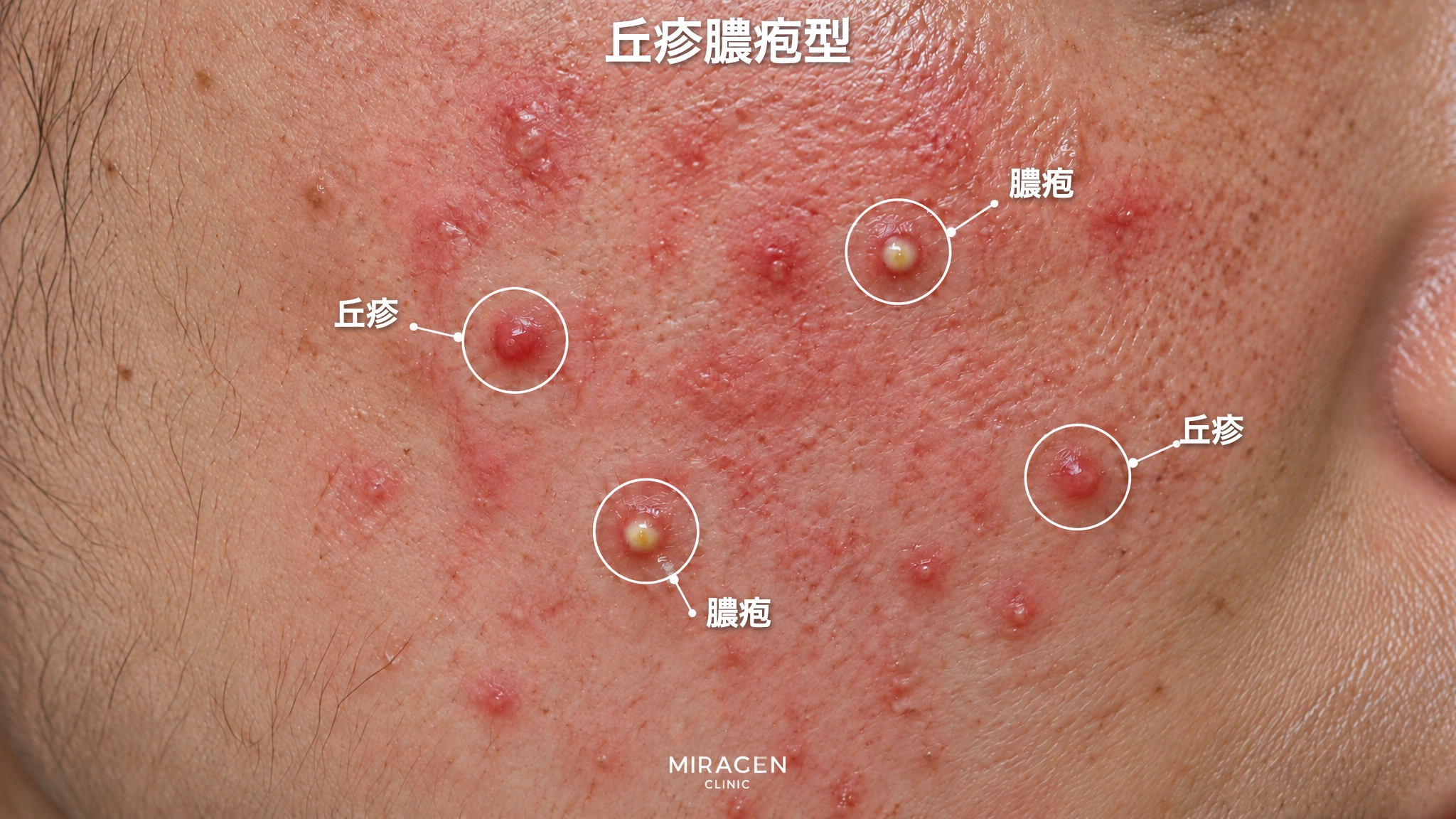 丘疹膿疱型：赤い頬に、赤い隆起と黄色い膿をもった隆起が散らばっている皮膚の拡大写真