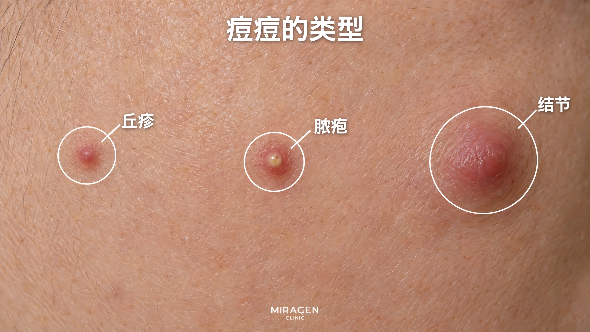 放大脸颊皮肤，圈出小而红的隆起丘疹、可见黄色脓液的脓疱，以及又大又深的肿胀结节的示意图