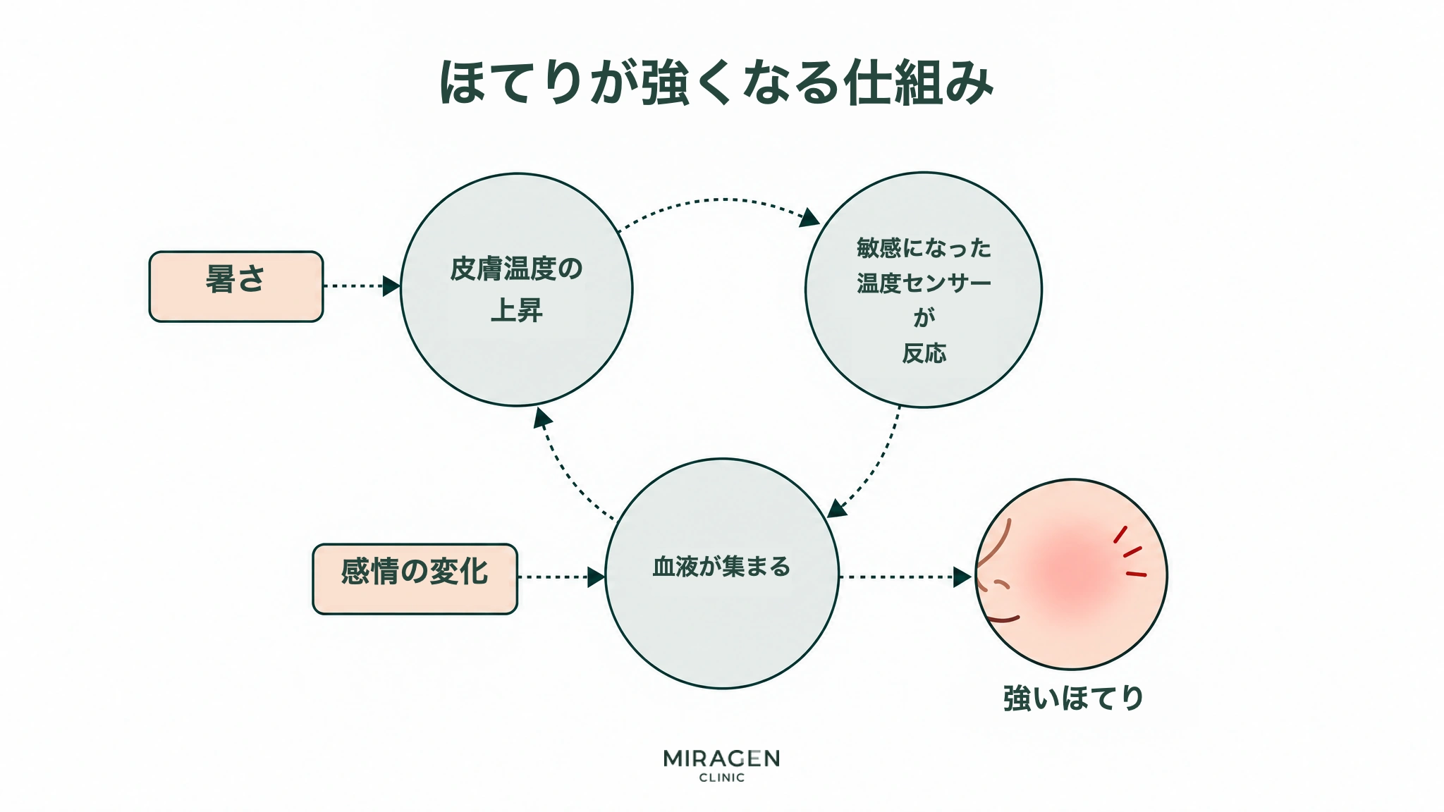 ほてりが強くなる過程の図。皮膚の温度上昇、敏感になった温度センサーの反応、血が集まることが輪のようにつながり、暑さは皮膚の温度上昇に、感情の変化は血が集まることに入って、最終的に強くほてる流れを示しています