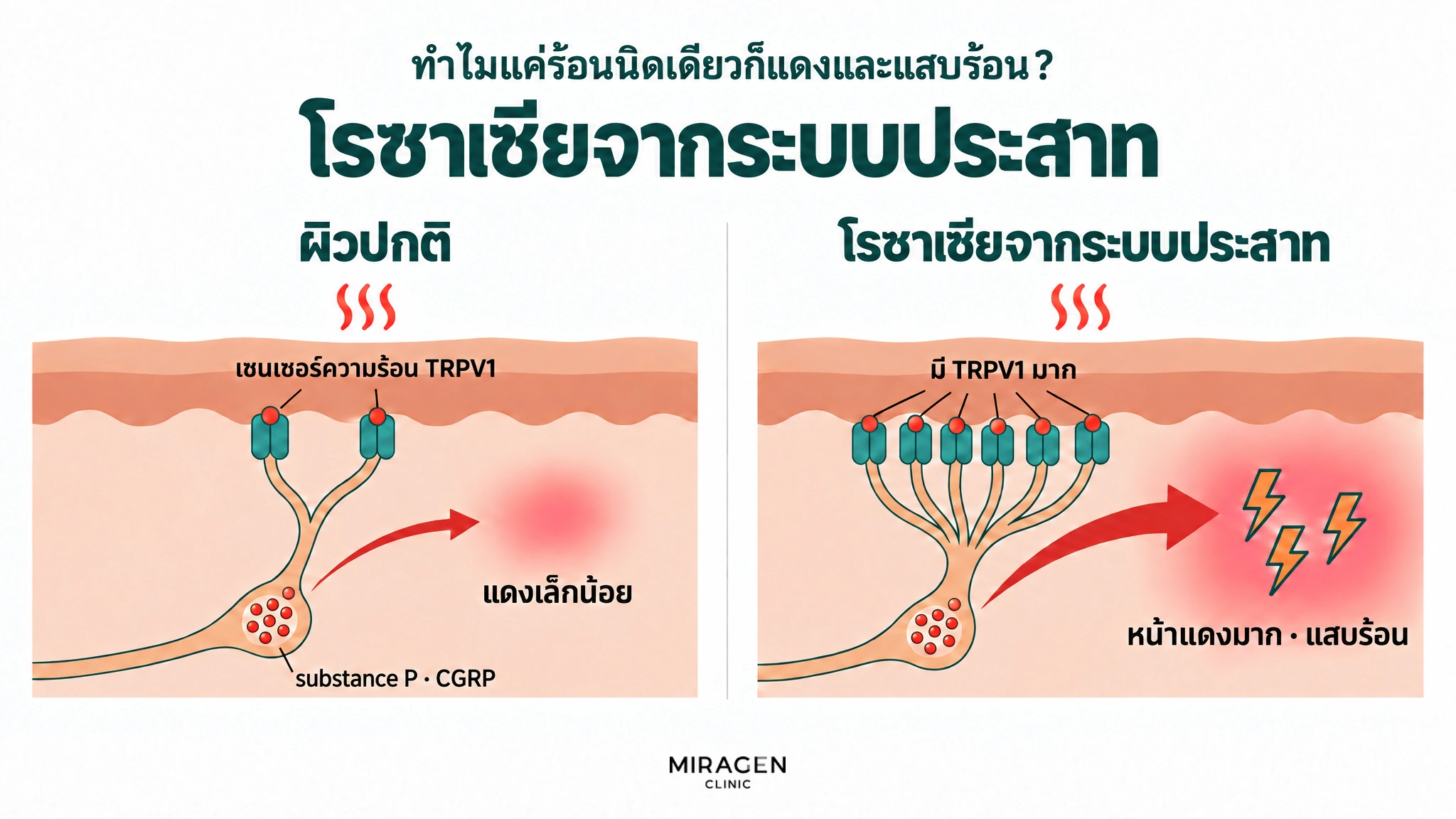 ภาพเปรียบเทียบสองช่อง ปริมาณ substance P · CGRP ในถุงประสาทใกล้เคียงกัน แต่เมื่อโดนความร้อนเท่ากัน ผิวปกติมี TRPV1 น้อยจึงหลั่งออกมาน้อยและแดงเล็กน้อย ส่วนโรซาเซียจากระบบประสาทมี TRPV1 มากจึงหลั่งออกมามากกว่าเยอะและเกิดหน้าแดงมากกับอาการแสบร้อน