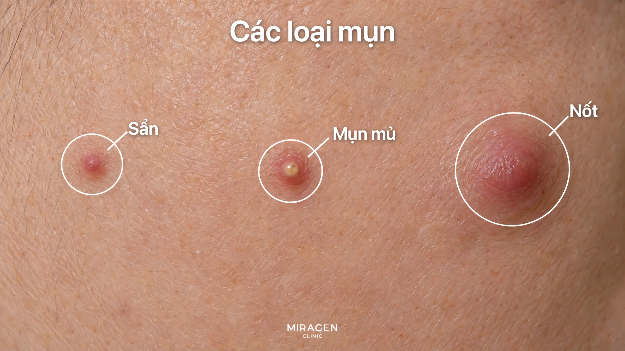 Hình phóng to da má, khoanh tròn sẩn nhỏ màu đỏ nhô lên, mụn mủ có mủ vàng và nốt sần to, sưng sâu