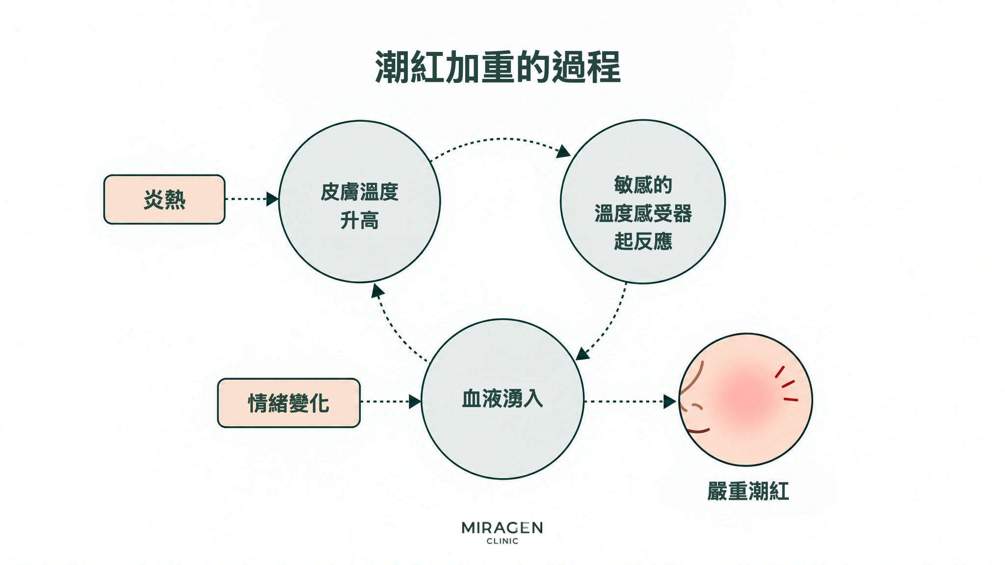 潮紅加劇過程的示意圖。皮膚溫度上升、變敏感的溫度感受器反應、血液湧入像環一樣相連；炎熱導致皮膚溫度上升，情緒變化導致血液湧入，最終形成嚴重潮紅的流程