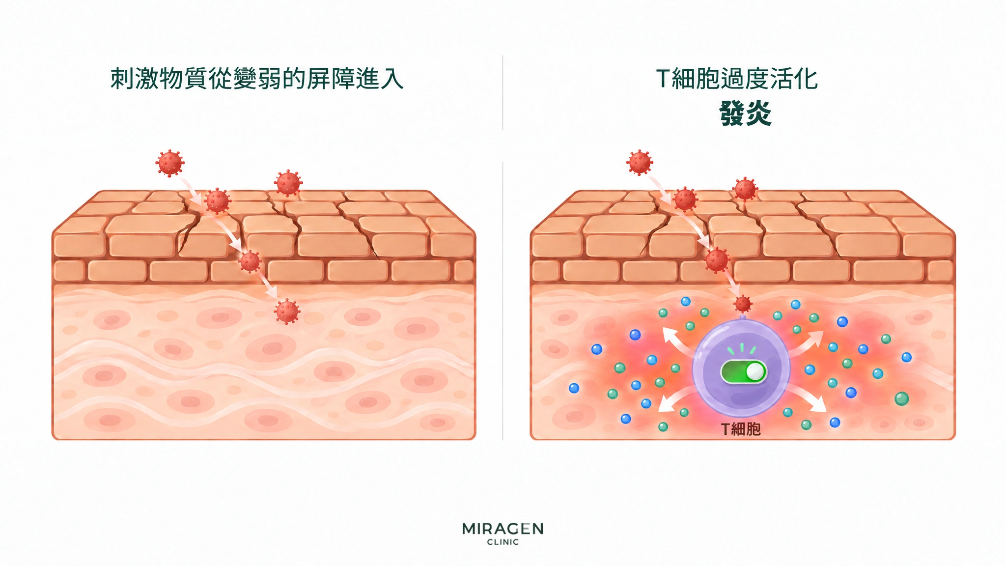 以左右兩格呈現:刺激物質從出現裂痕的皮膚屏障進入,皮膚內T細胞的開關被打開,發炎物質擴散並使皮膚發紅