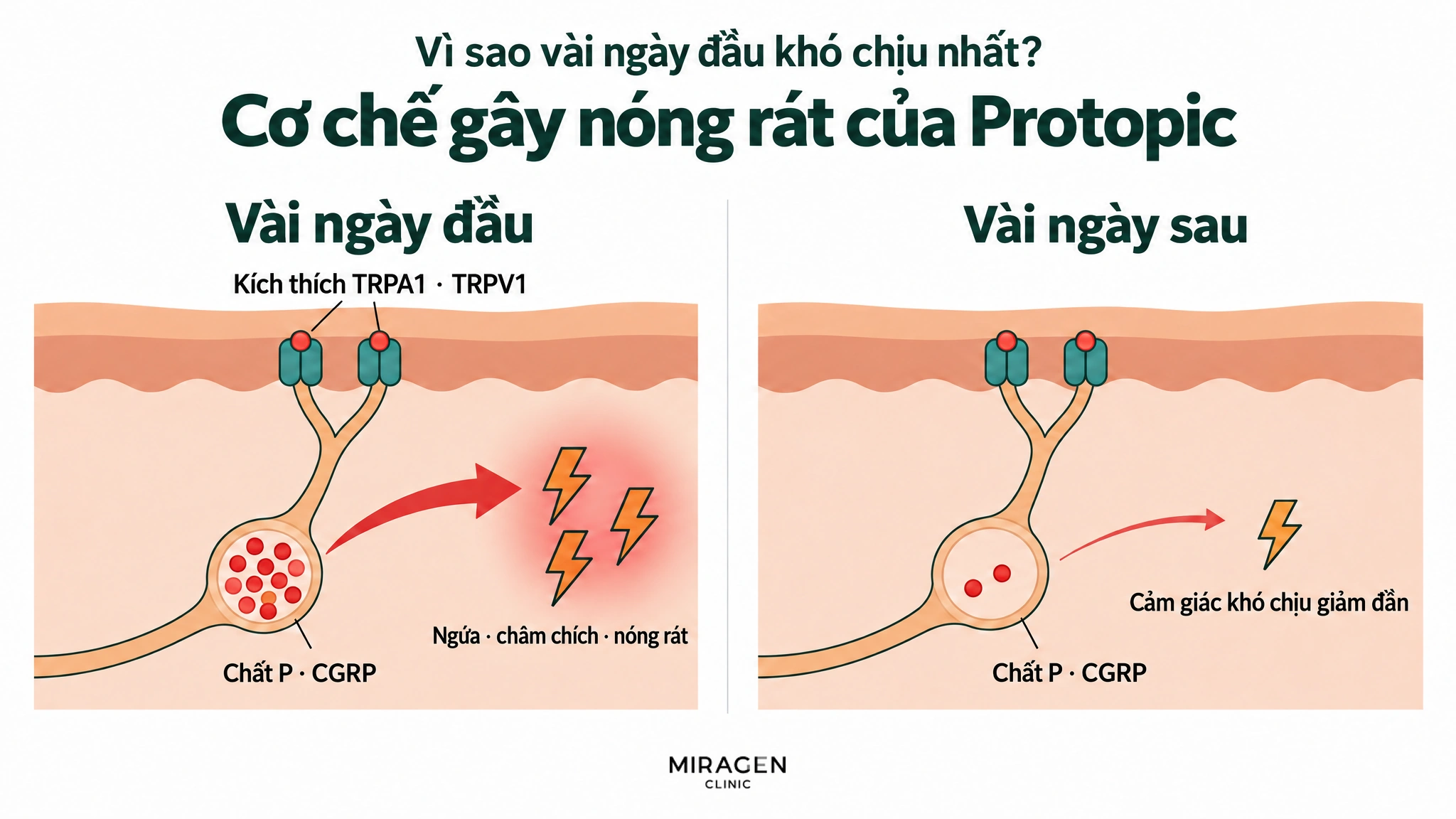 Hình so sánh hai khung: những ngày đầu TRPA1 · TRPV1 bị kích thích, chất P và CGRP đầy trong túi thần kinh được giải phóng gây ngứa · châm chích · nóng rát; vài ngày sau túi gần như cạn nên cảm giác khó chịu giảm