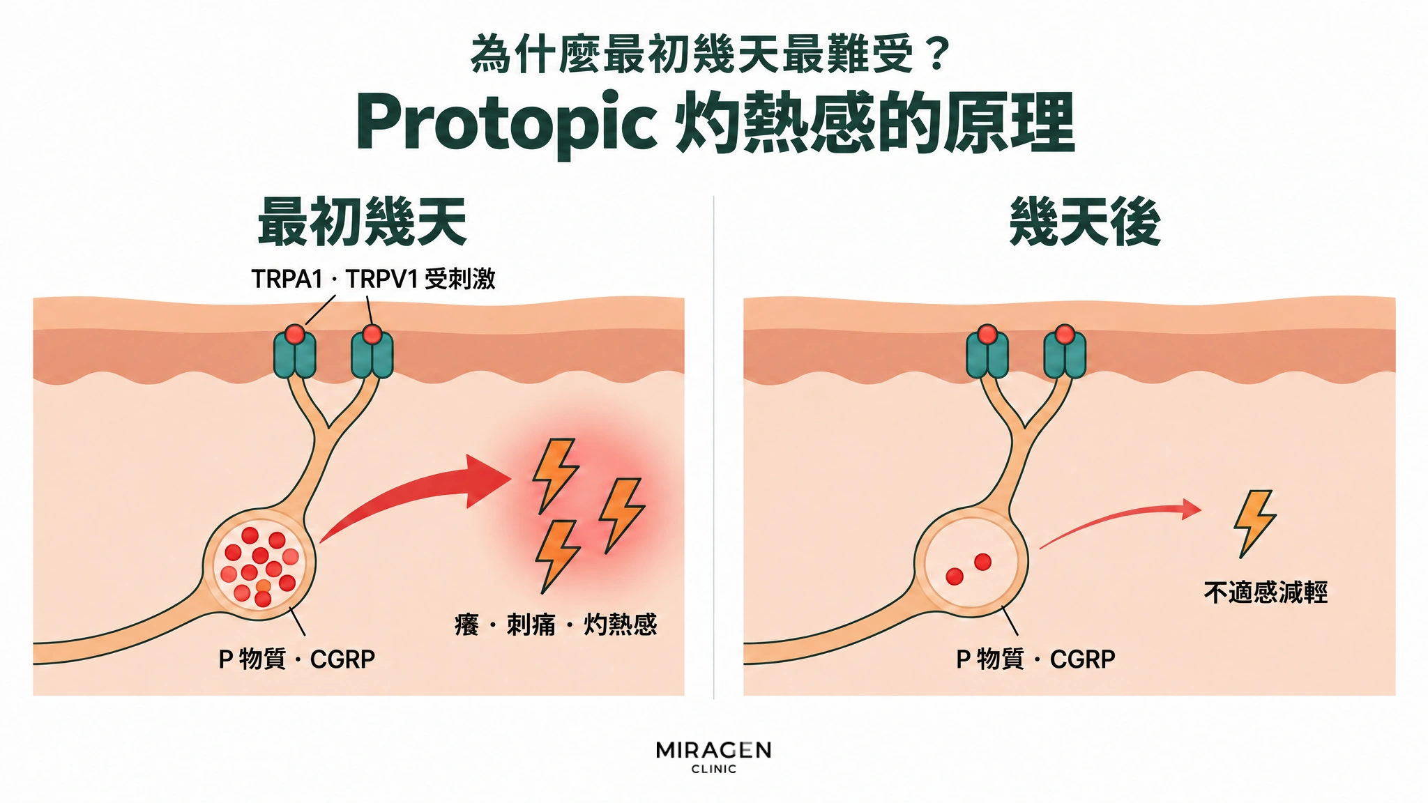 以兩格對照的圖：最初幾天 TRPA1 · TRPV1 受到刺激，神經囊袋中滿滿的 P 物質和 CGRP 釋放出來，造成癢、刺痛、灼熱；幾天後囊袋幾乎已空，不適感減輕