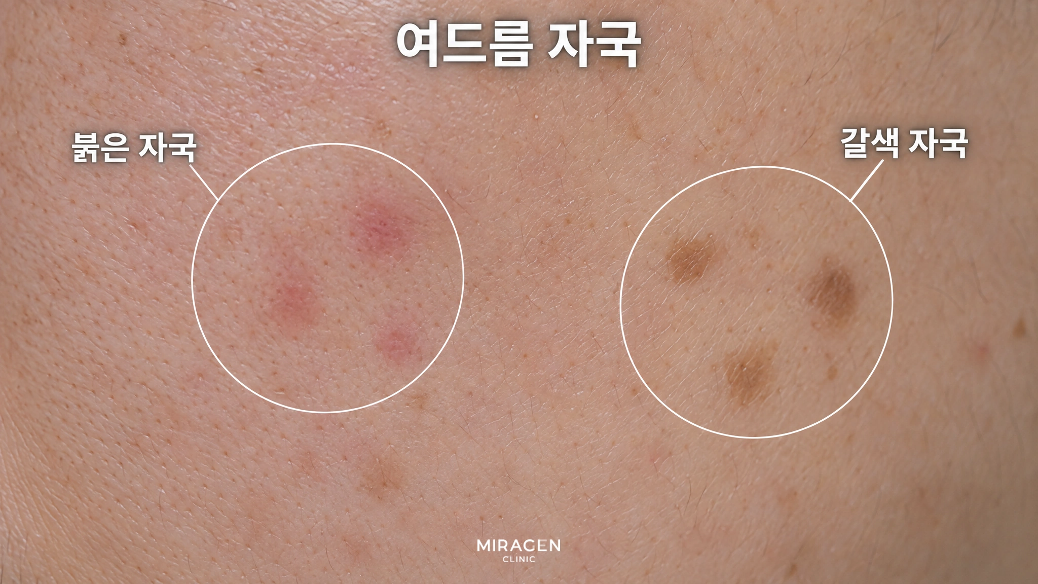 뺨 피부를 확대해 평평한 붉은 자국과 갈색 자국을 동그라미로 표시한 그림