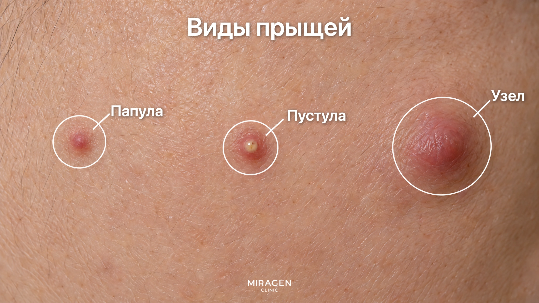 Увеличенный участок кожи щеки, где кружками отмечены маленькая красная возвышающаяся папула, пустула с жёлтым гноем и крупный глубокий отёчный узел