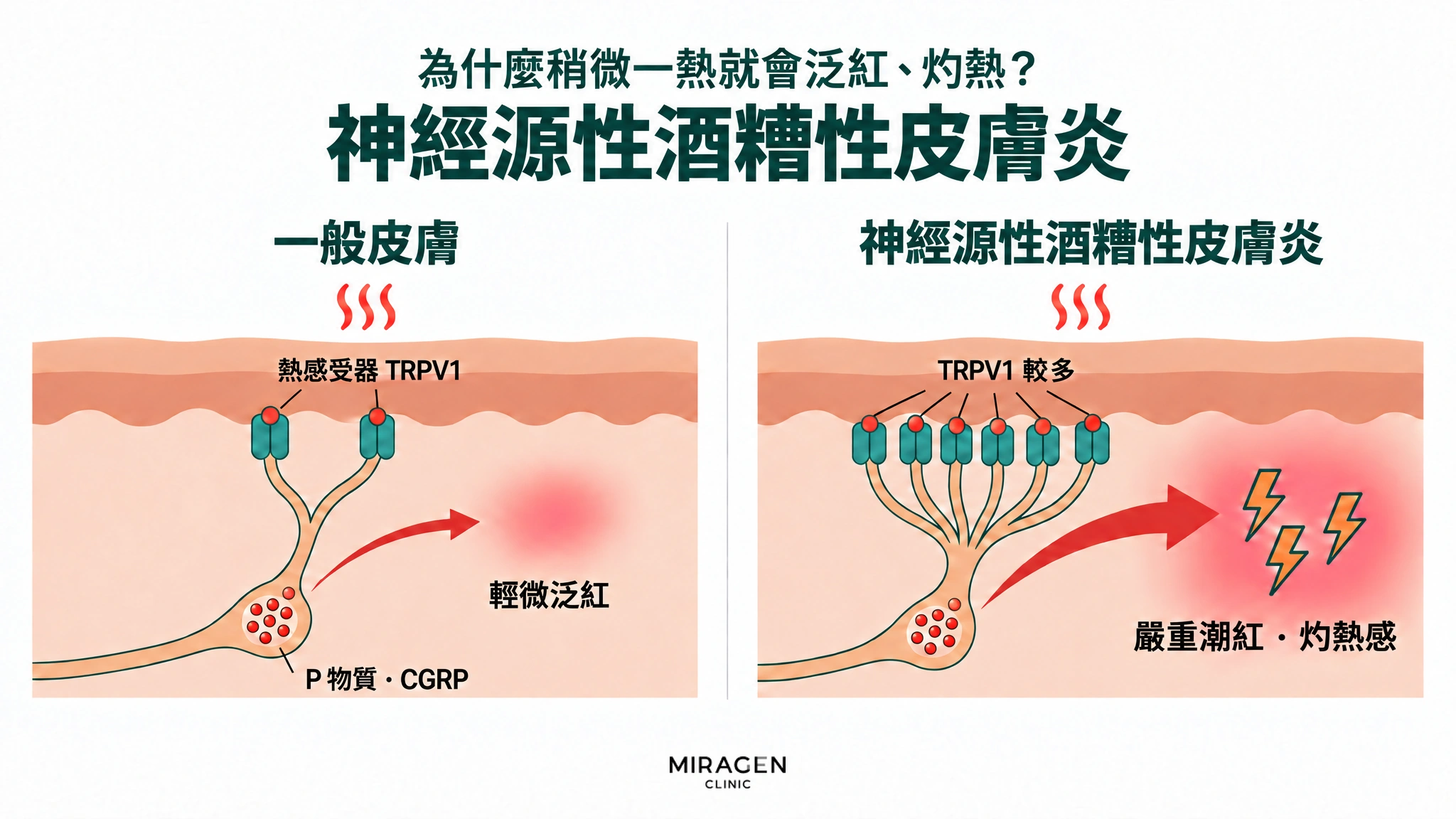 以兩格對照的圖：神經囊袋中的 P 物質 · CGRP 量相近，但面對同樣的熱刺激，一般皮膚的 TRPV1 少，釋放得少，只會輕微泛紅；神經源性酒糟性皮膚炎的 TRPV1 多，釋放得多得多，出現嚴重潮紅和灼熱感