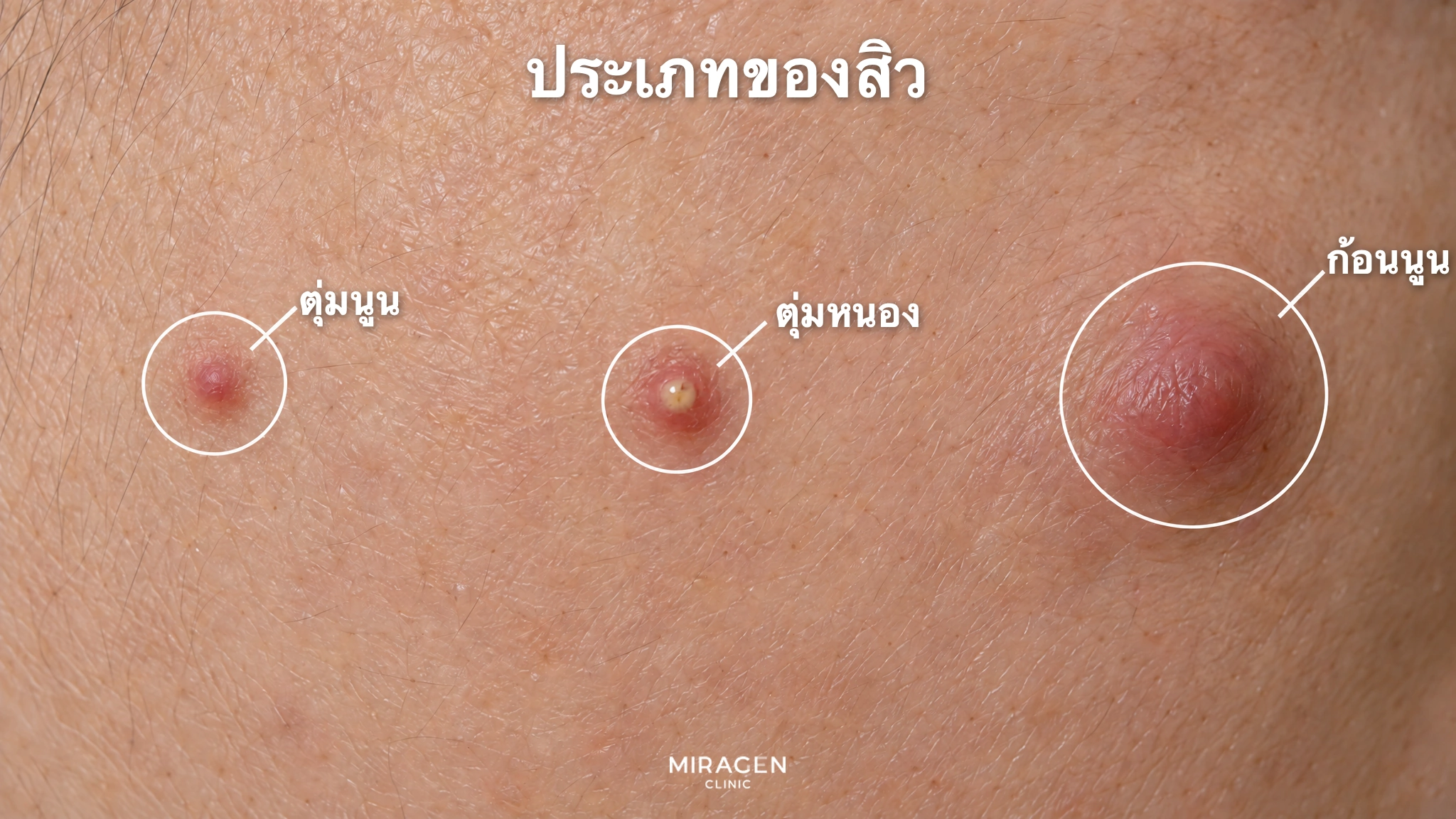 ภาพขยายผิวแก้มที่วงกลมแสดงตุ่มนูนแดงขนาดเล็ก ตุ่มหนองที่เห็นหนองสีเหลือง และตุ่มก้อนลึกที่บวมใหญ่