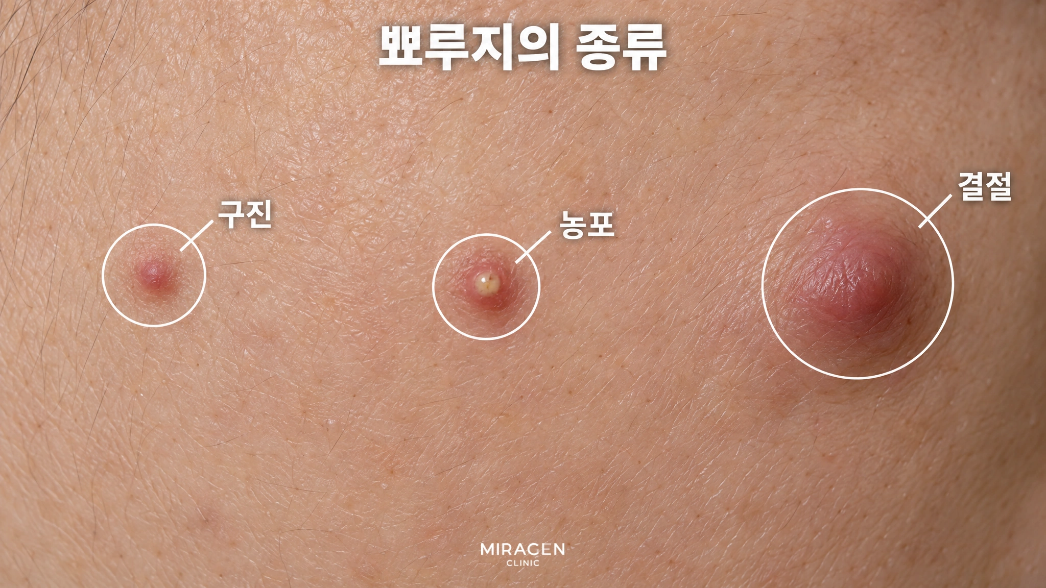 뺨 피부를 확대해 작고 붉게 솟은 구진, 노란 고름이 보이는 농포, 크고 깊게 부은 결절을 동그라미로 표시한 그림