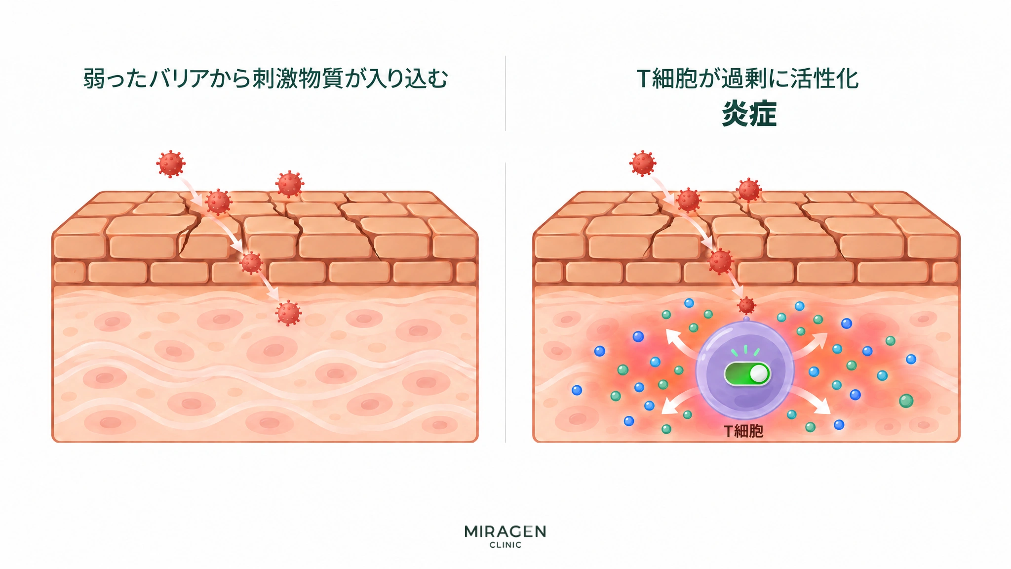 ひび割れた皮膚バリアから刺激物質が入り込み、皮膚の中のT細胞のスイッチがオンになって炎症物質が広がり赤くなる様子を、2コマで示した図