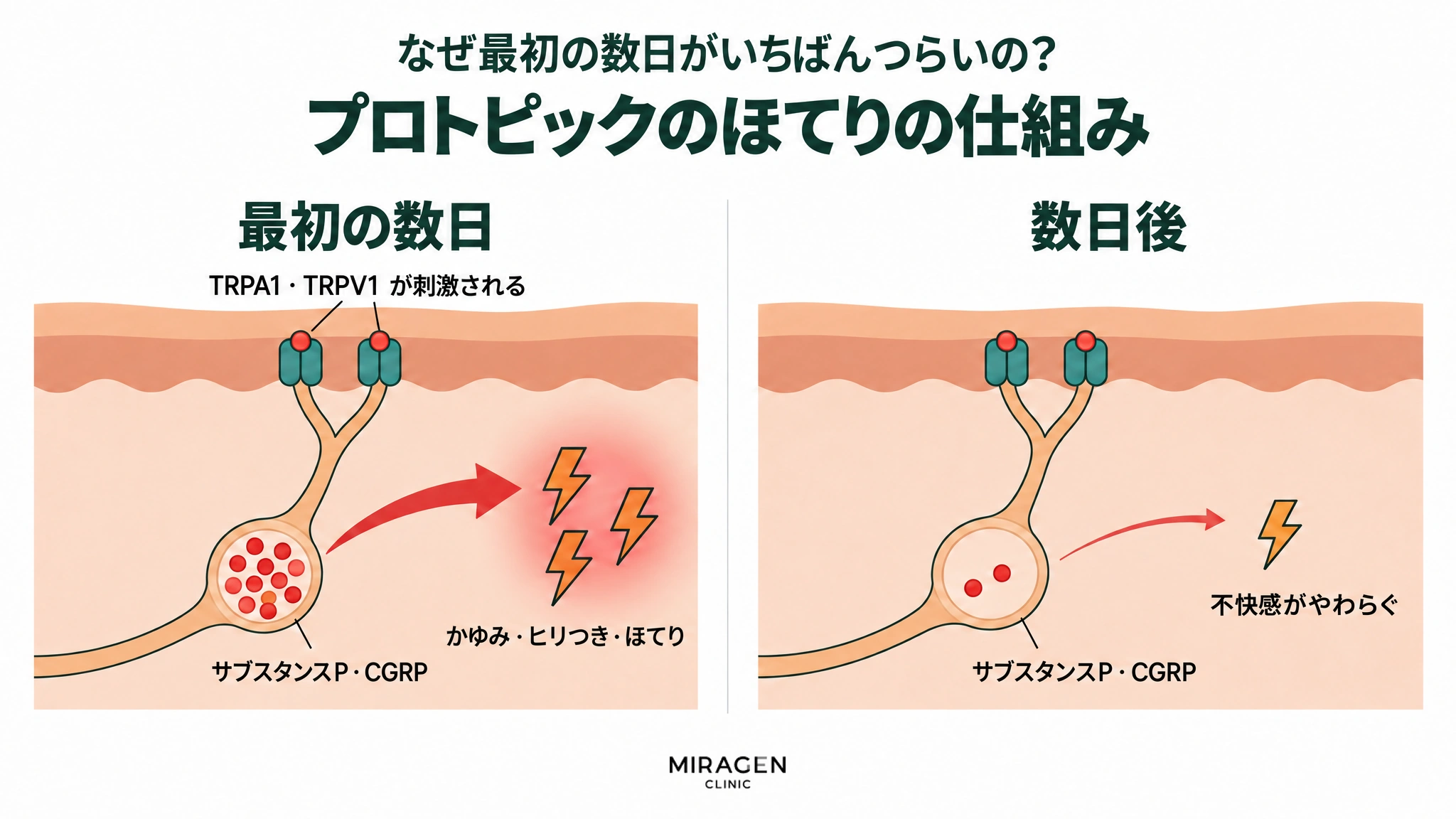 最初の数日はTRPA1 · TRPV1が刺激されて、神経の袋にいっぱいに入ったサブスタンスPとCGRPが出てかゆみ · ヒリつき · ほてりが起こり、数日後は袋がほぼ空になって不快感がやわらぐ様子を、2つのコマで比べた図