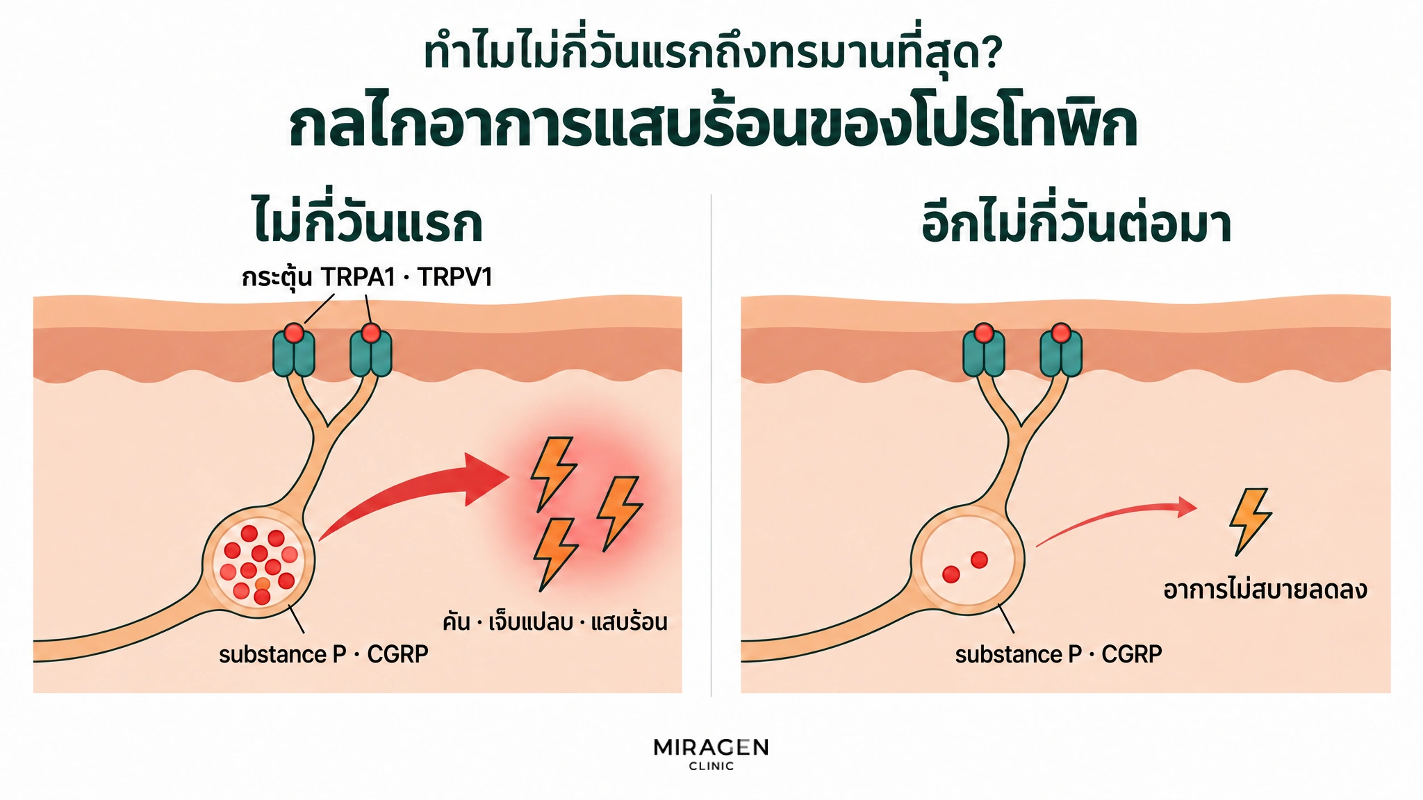 ภาพเปรียบเทียบสองช่อง ช่วงไม่กี่วันแรก TRPA1 · TRPV1 ถูกกระตุ้น ทำให้ substance P และ CGRP ที่เต็มถุงประสาทหลั่งออกมา เกิดอาการคัน เจ็บแปลบ แสบร้อน ส่วนอีกไม่กี่วันต่อมาถุงแทบว่างเปล่าและอาการไม่สบายลดลง