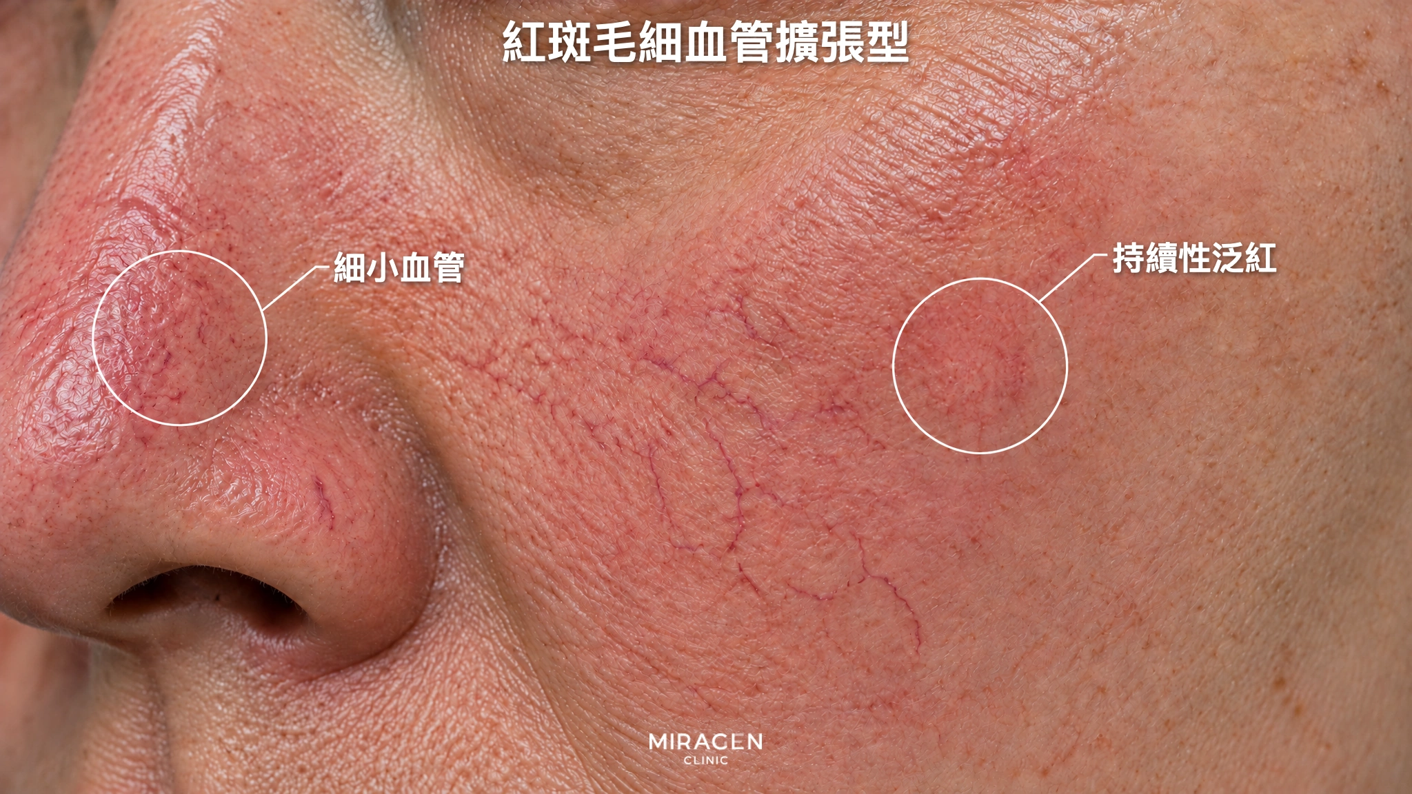 紅斑毛細血管擴張型：鼻翼旁與臉頰泛紅，可見細小血絲的皮膚放大照片