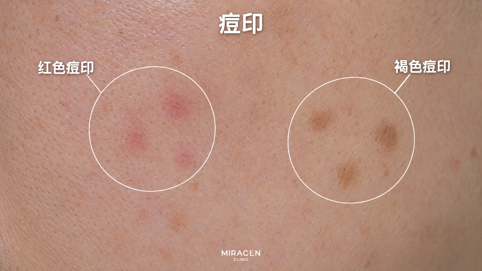 放大脸颊皮肤，圈出平坦的红色痘印和褐色痘印的示意图