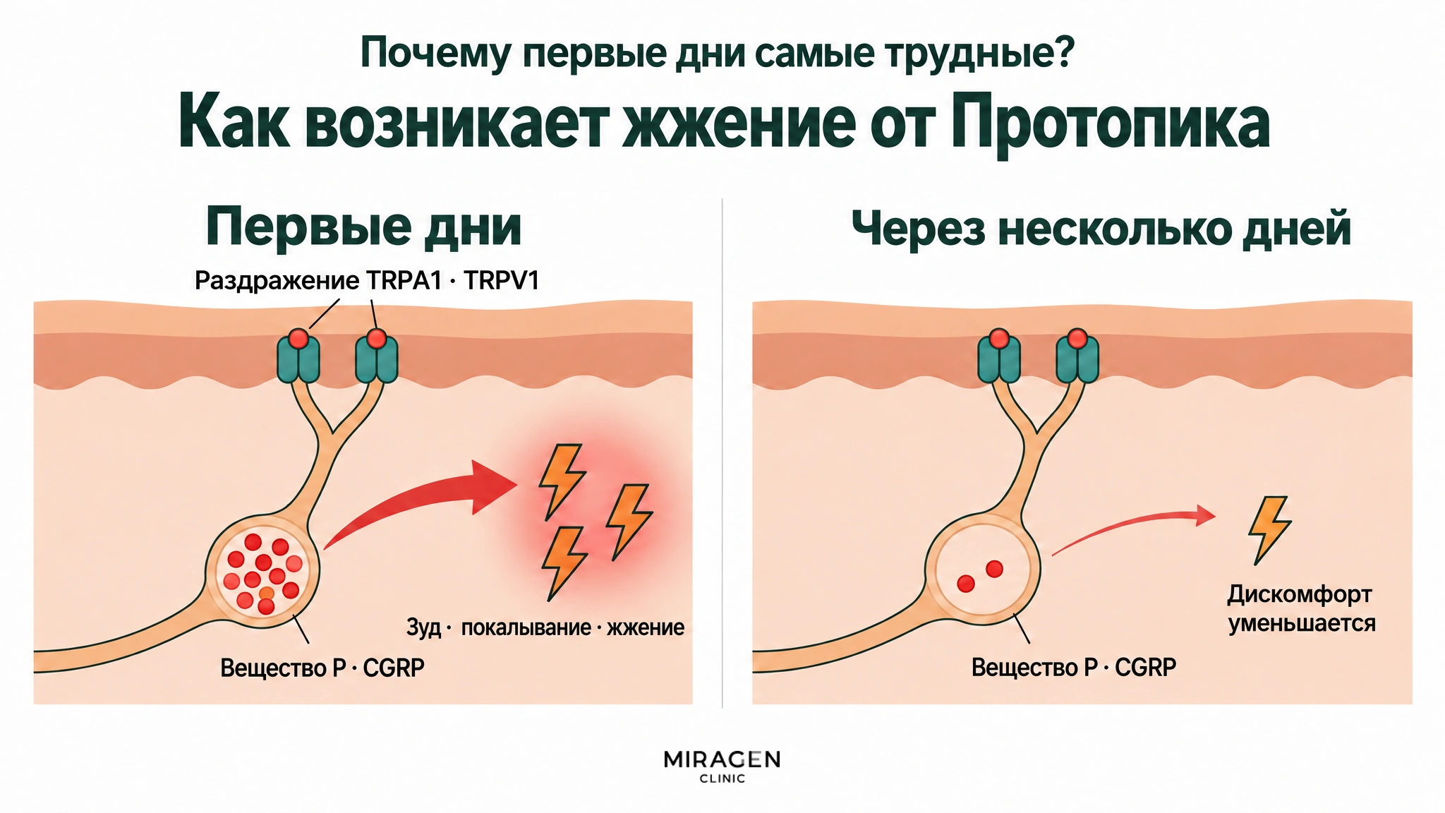 Сравнение в двух частях: в первые дни раздражаются TRPA1 · TRPV1, из переполненного нервного мешочка выходят вещество P и CGRP и вызывают зуд, покалывание и жжение; через несколько дней мешочек почти пуст, и дискомфорт уменьшается