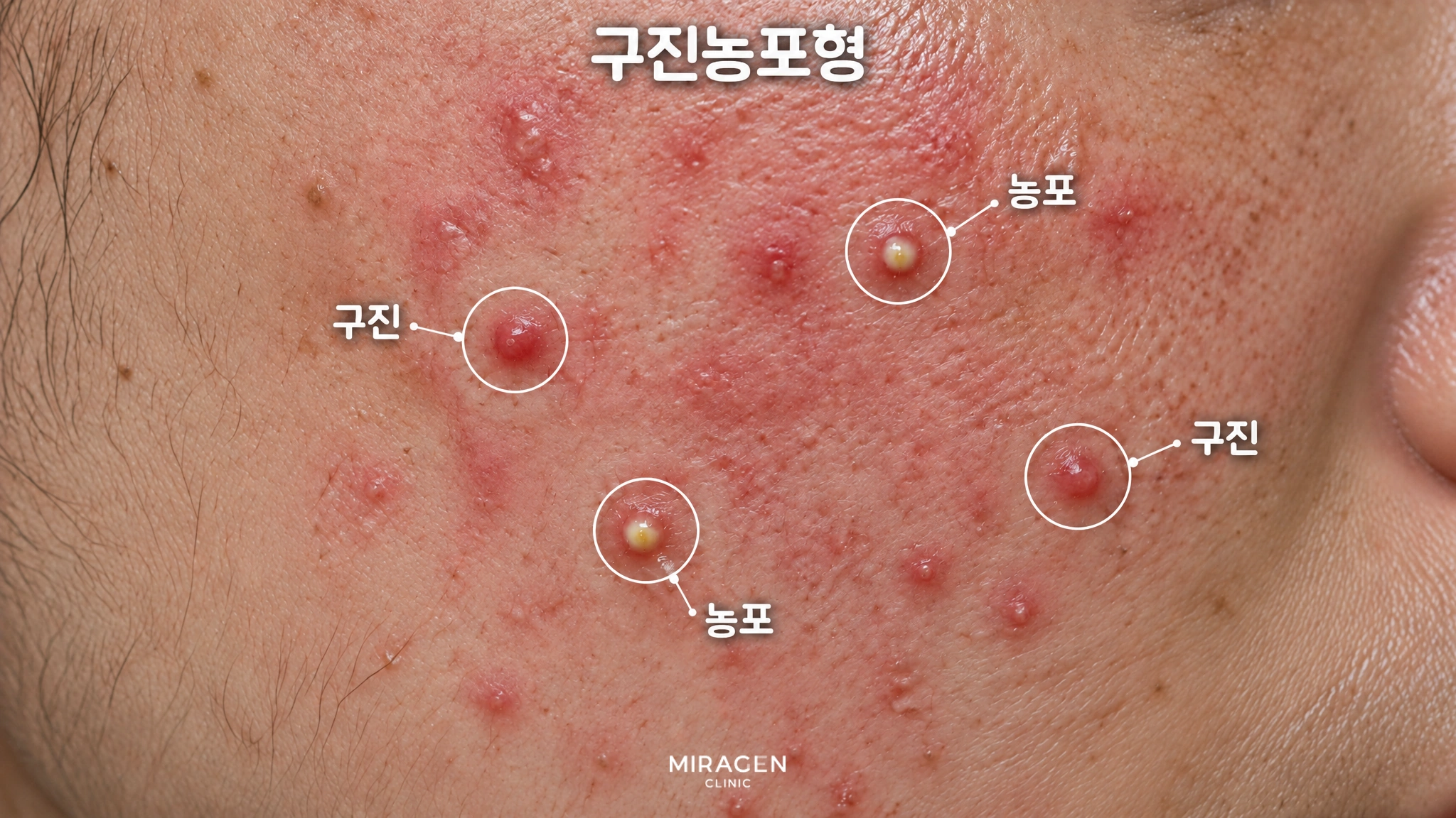 구진농포형: 붉은 뺨에 붉은 돌기와 노란 고름이 맺힌 돌기가 흩어져 있는 피부 확대 사진