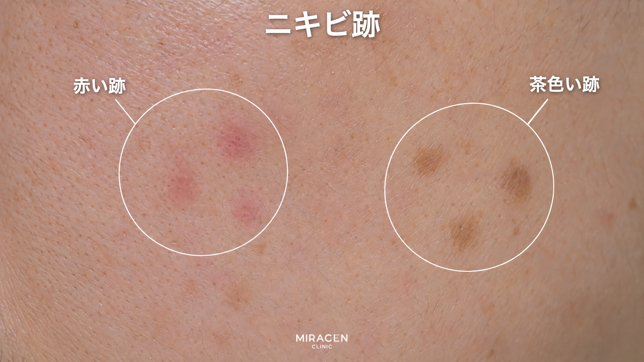 頬の皮膚を拡大し、平らな赤い跡と茶色い跡を丸で示したイラスト