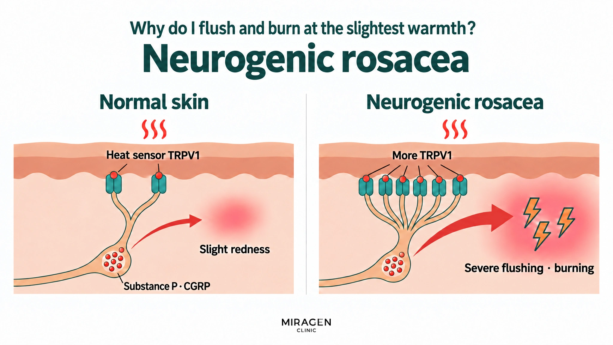 A two-panel diagram. The amount of substance P · CGRP in the nerve pouch is similar, but with the same heat stimulus, normal skin has little TRPV1, so only a little is released and the skin turns slightly red, while in neurogenic rosacea there is more TRPV1, so much more is released and severe flushing and burning occur