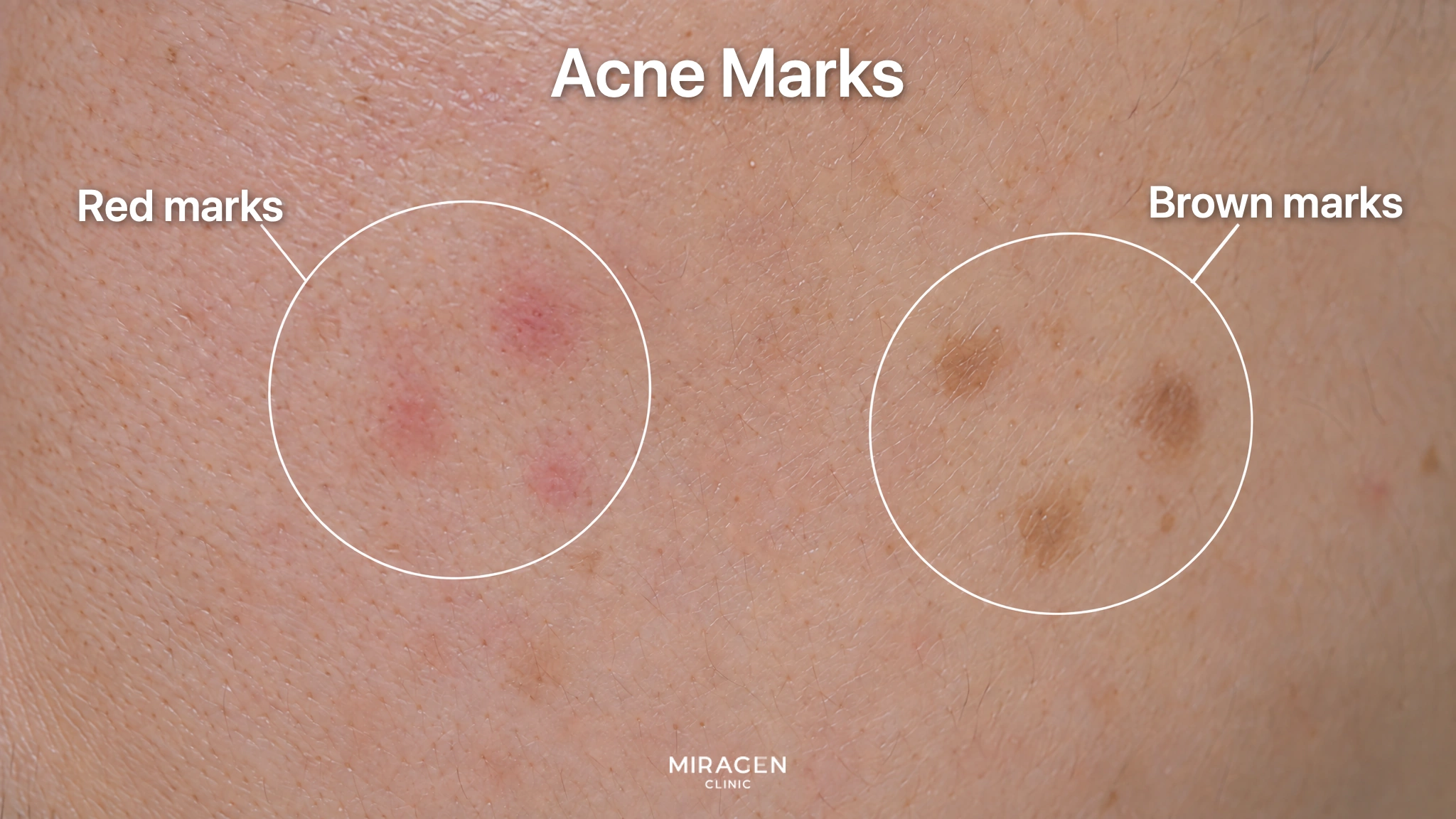 A magnified view of cheek skin with circles marking flat red marks and brown marks