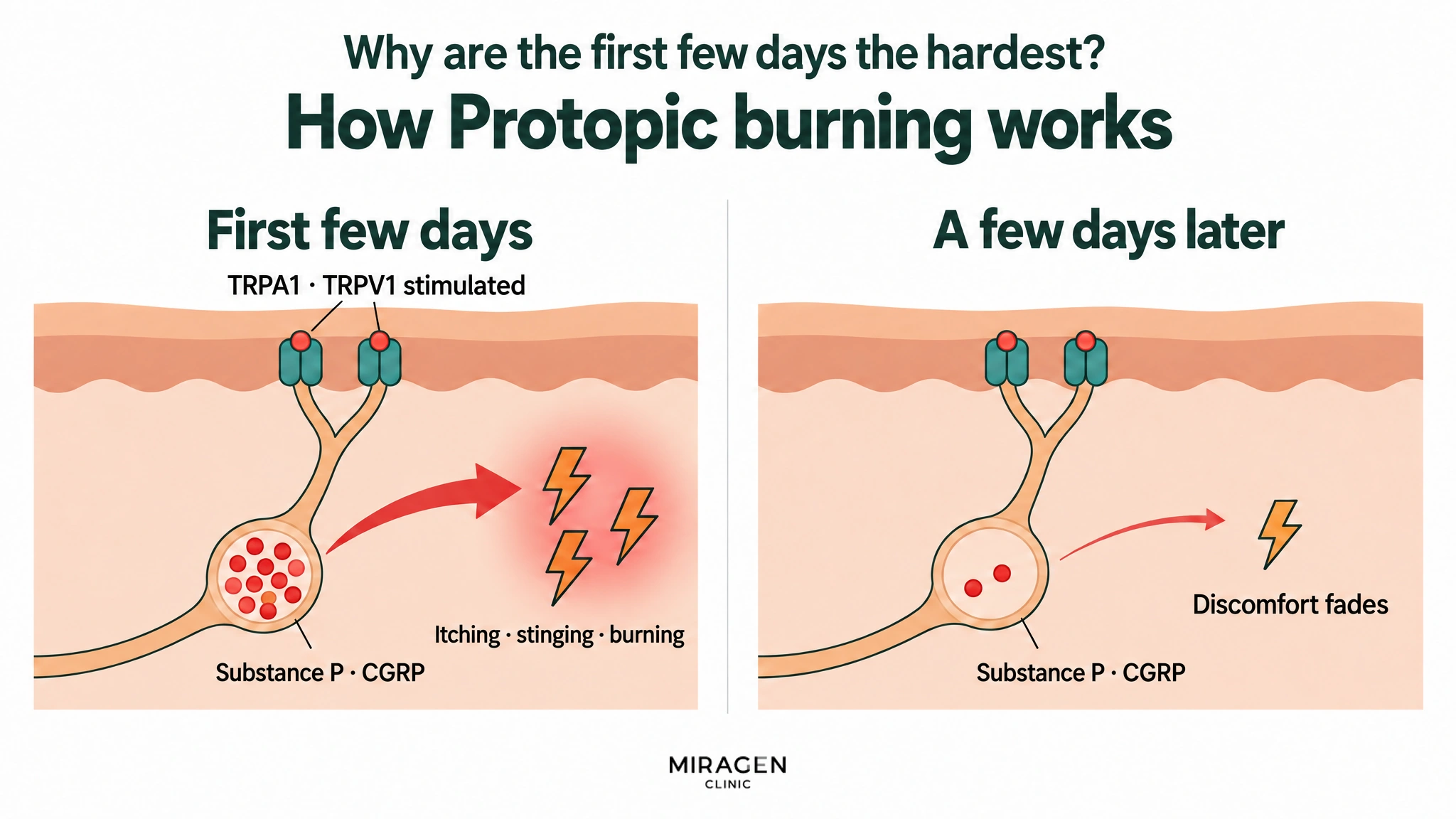 A two-panel diagram. In the first few days, TRPA1 · TRPV1 are stimulated, the substance P and CGRP filling the nerve pouch are released, and itching · stinging · burning occur. A few days later, the pouch is almost empty and the discomfort fades