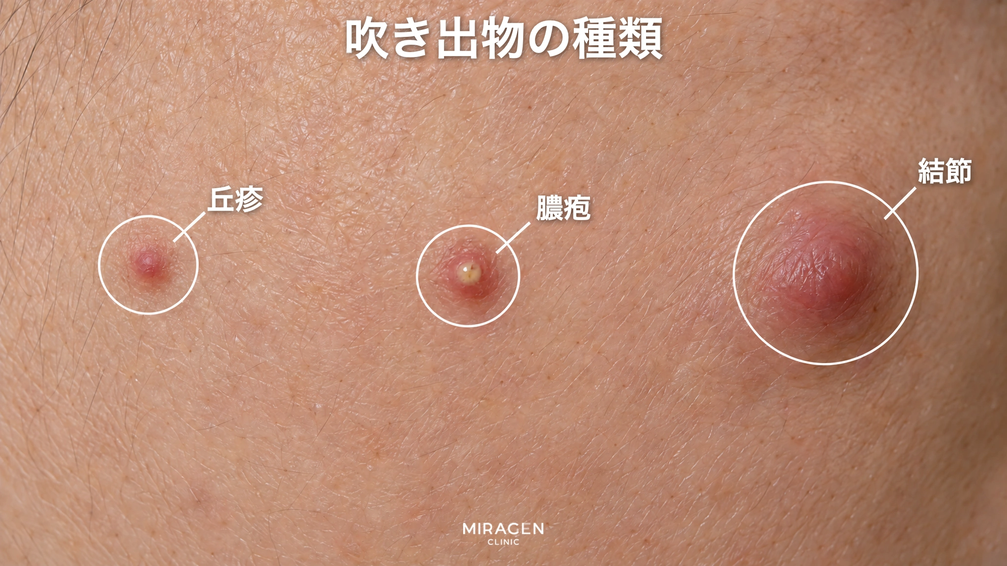 頬の皮膚を拡大し、小さく赤く盛り上がった丘疹、黄色い膿が見える膿疱、大きく深く腫れた結節を丸で示したイラスト