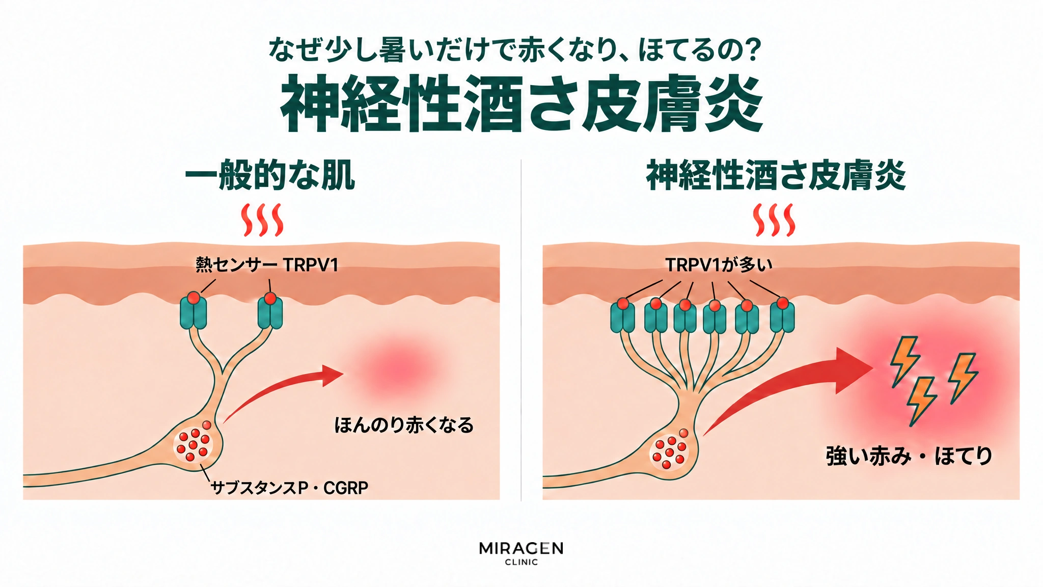 神経の袋の中のサブスタンスP · CGRPの量は同じくらいでも、同じ熱の刺激に対して、一般的な肌はTRPV1が少なくて少しだけ出て、ほんのり赤くなり、神経性酒さ皮膚炎はTRPV1が多くてはるかに多く出て、強い赤みとほてりが起こる様子を、2つのコマで比べた図
