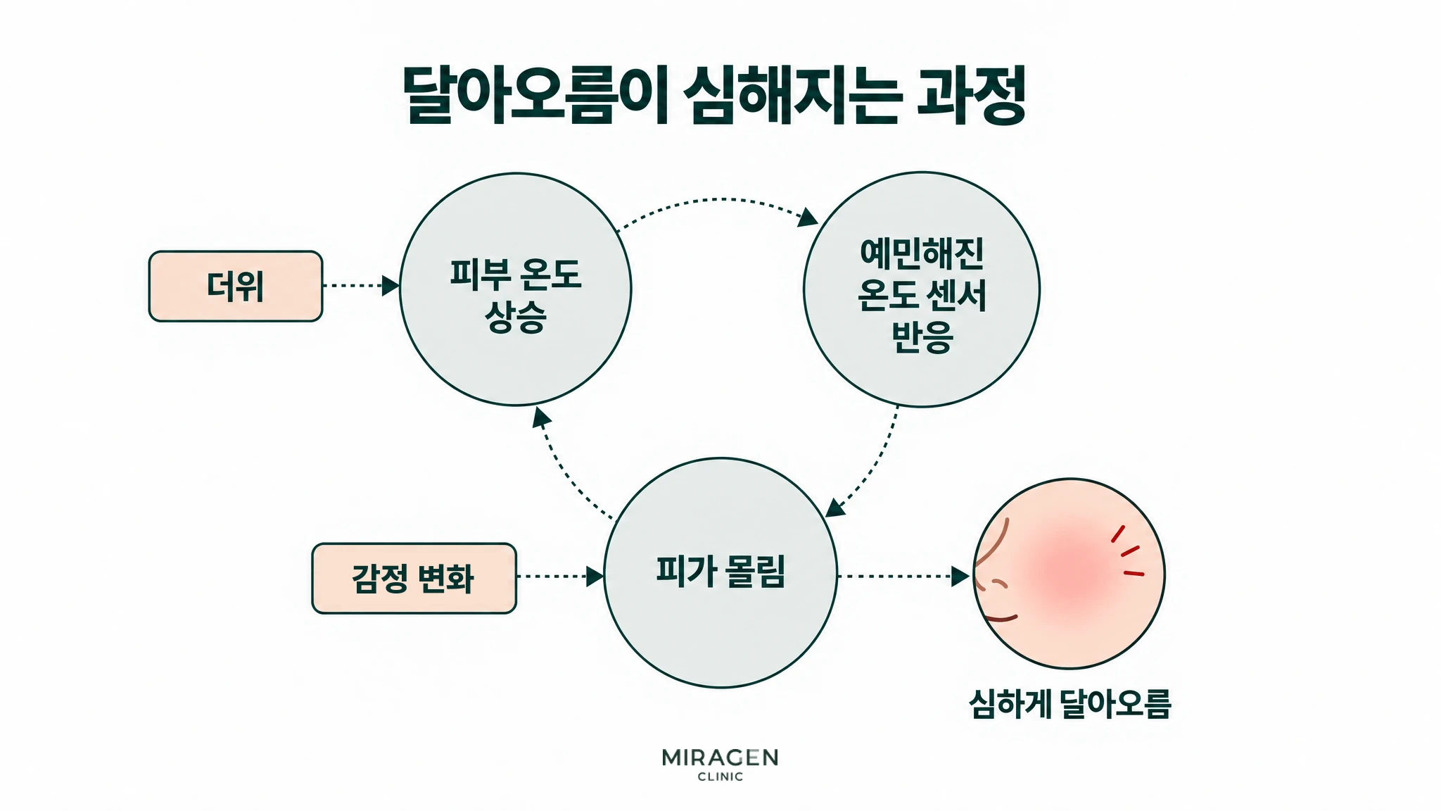 달아오름이 심해지는 과정 그림. 피부 온도 상승, 예민해진 온도 센서 반응, 피가 몰림이 고리처럼 이어지고, 더위는 피부 온도 상승으로, 감정 변화는 피가 몰림으로 들어가 결국 심하게 달아오르는 흐름을 보여 줍니다