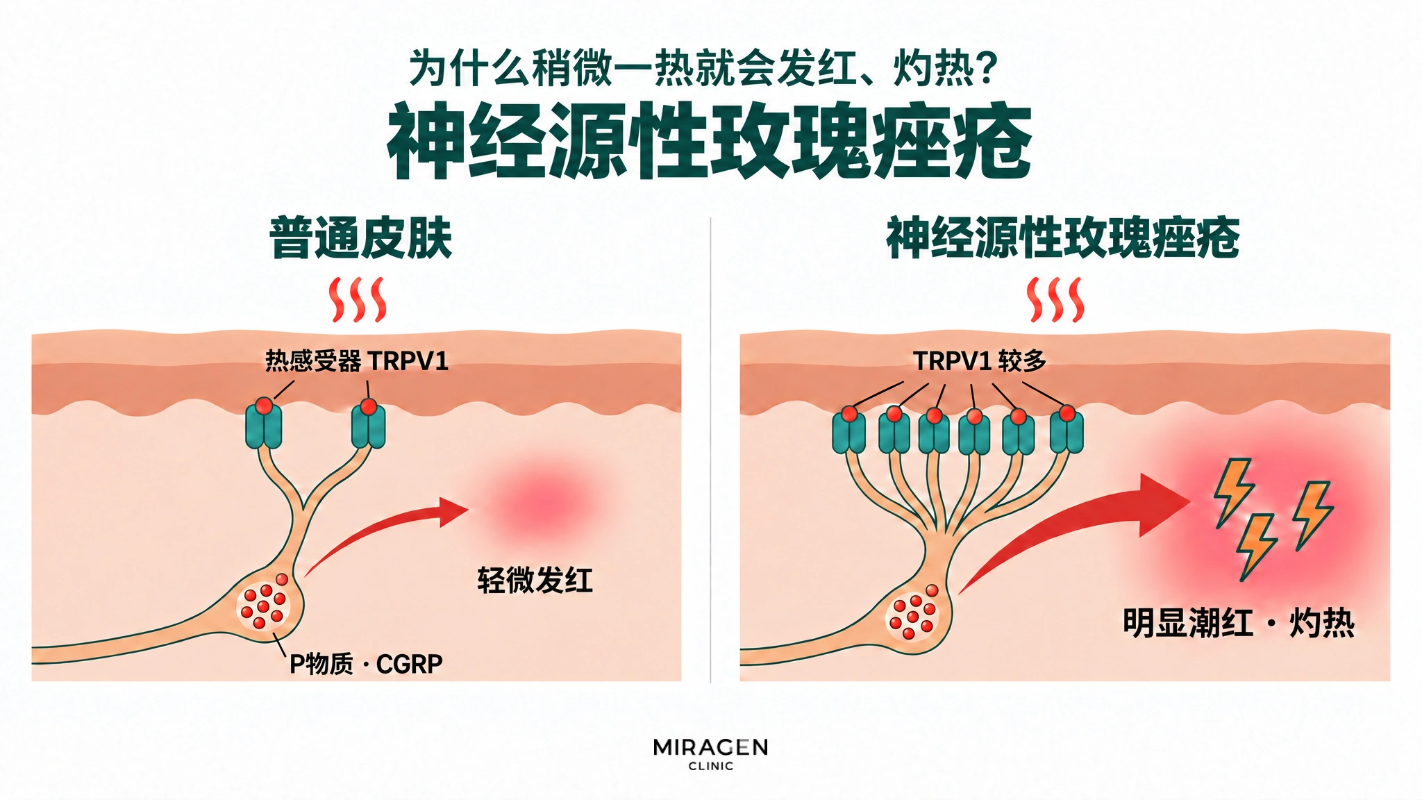分两栏对比的示意图:神经囊袋中 P物质 · CGRP 的量相近,但受到同样的热刺激时,普通皮肤 TRPV1 较少,释放得少,只是轻微发红;神经源性玫瑰痤疮 TRPV1 较多,释放得多得多,出现明显潮红和灼热