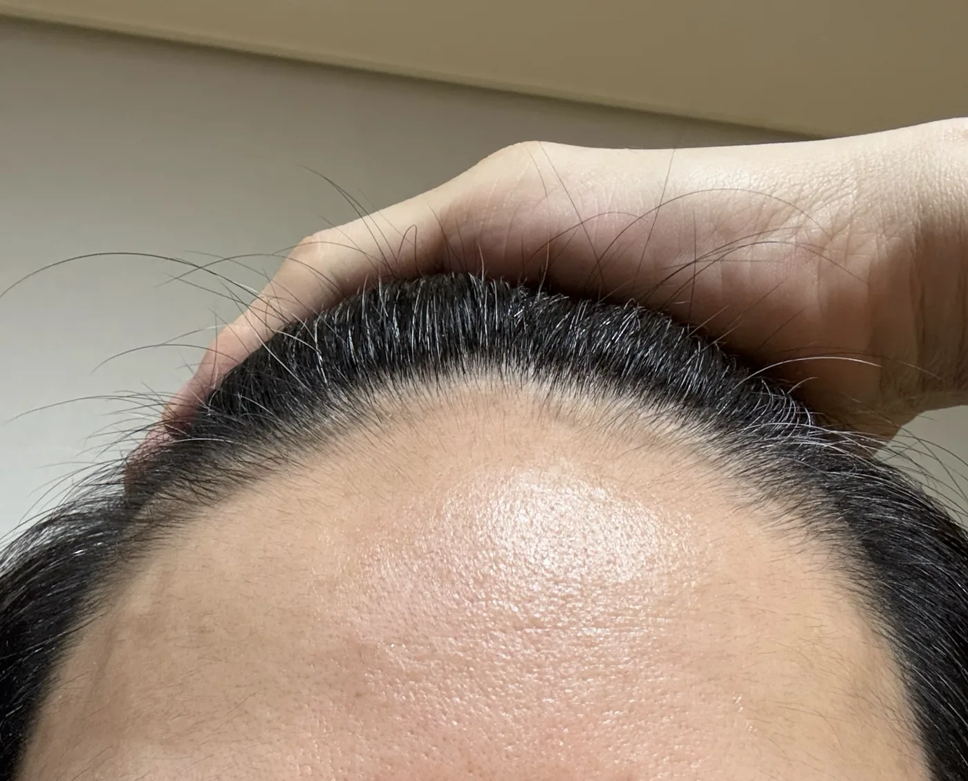 영상의 모낭충이 살던 원장의 이마를 찍은 사진으로, 붉은기나 오돌토돌한 병변 없이 깨끗한 모습