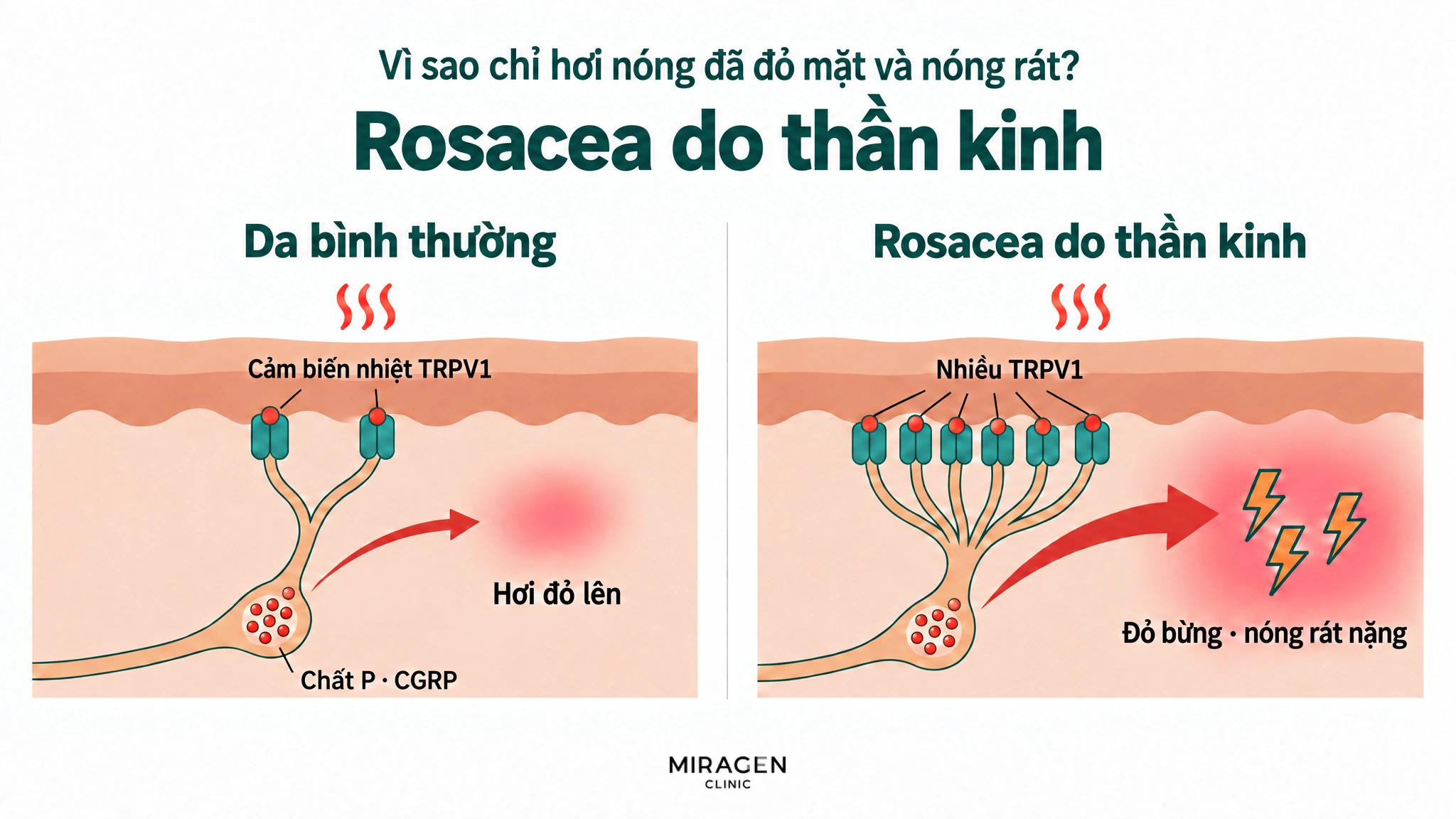 Hình so sánh hai khung: lượng chất P · CGRP trong túi thần kinh tương tự nhau, nhưng với cùng một kích thích nhiệt, da bình thường có ít TRPV1 nên chỉ giải phóng ít và hơi đỏ lên, còn rosacea do thần kinh có nhiều TRPV1 nên giải phóng nhiều hơn hẳn, gây đỏ bừng và nóng rát nặng