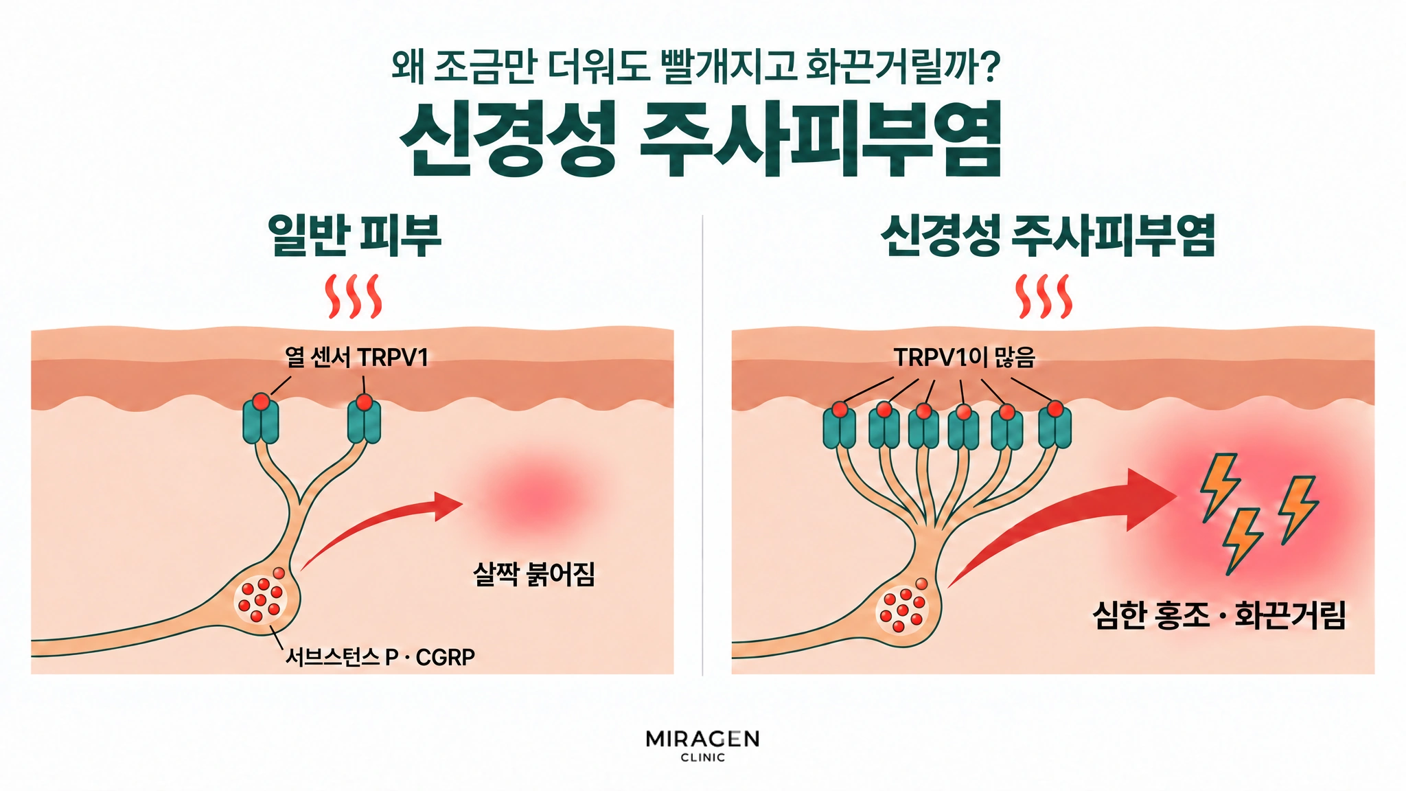 신경 주머니 속 서브스턴스 P · CGRP 양은 비슷하지만, 같은 열 자극에 일반 피부는 TRPV1이 적어 조금만 나와 살짝 붉어지고, 신경성 주사피부염은 TRPV1이 많아 훨씬 많이 나와 심한 홍조와 화끈거림이 생기는 것을 두 칸으로 비교한 그림