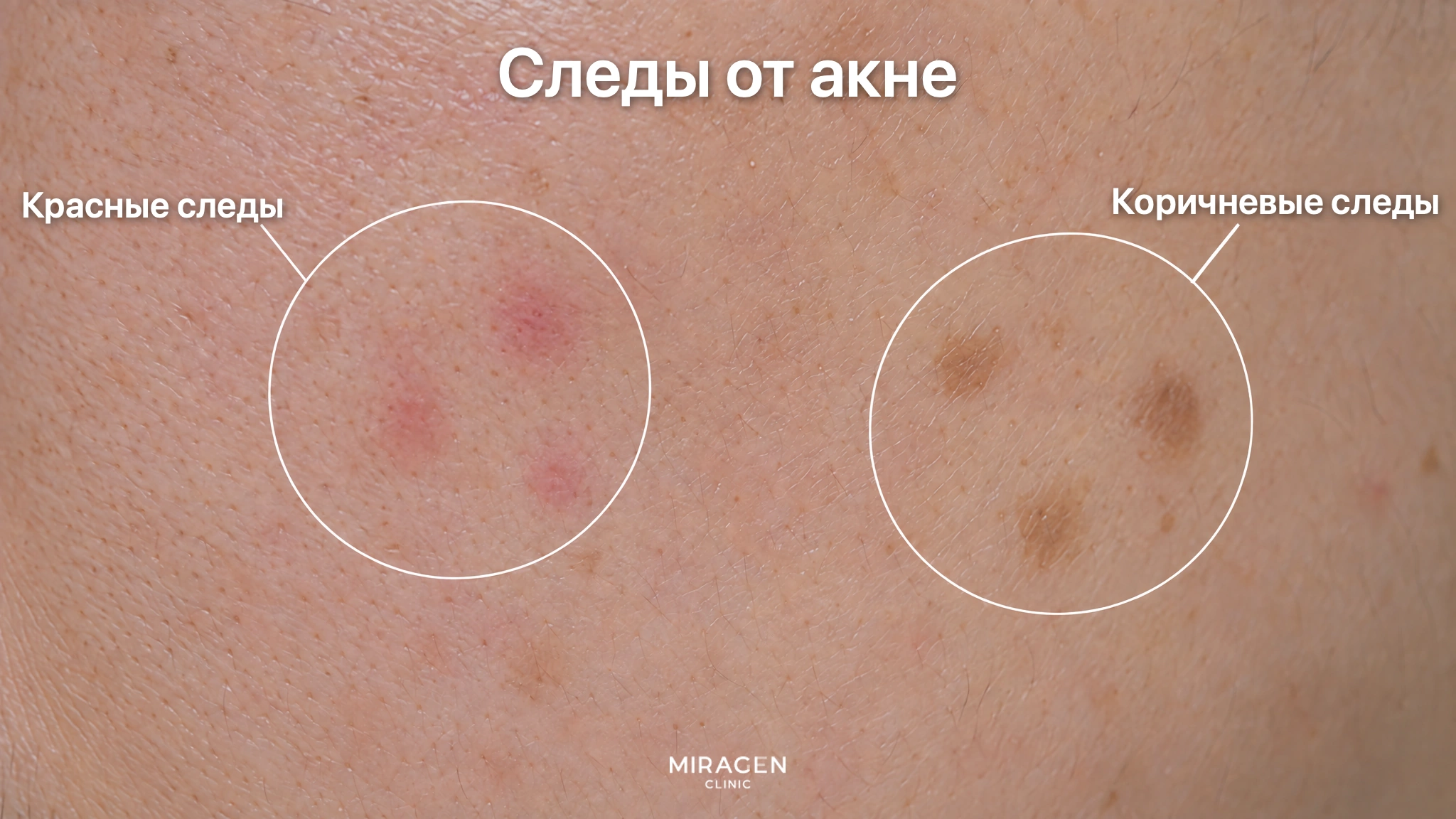 Увеличенный участок кожи щеки, где кружками отмечены плоские красные и коричневые следы