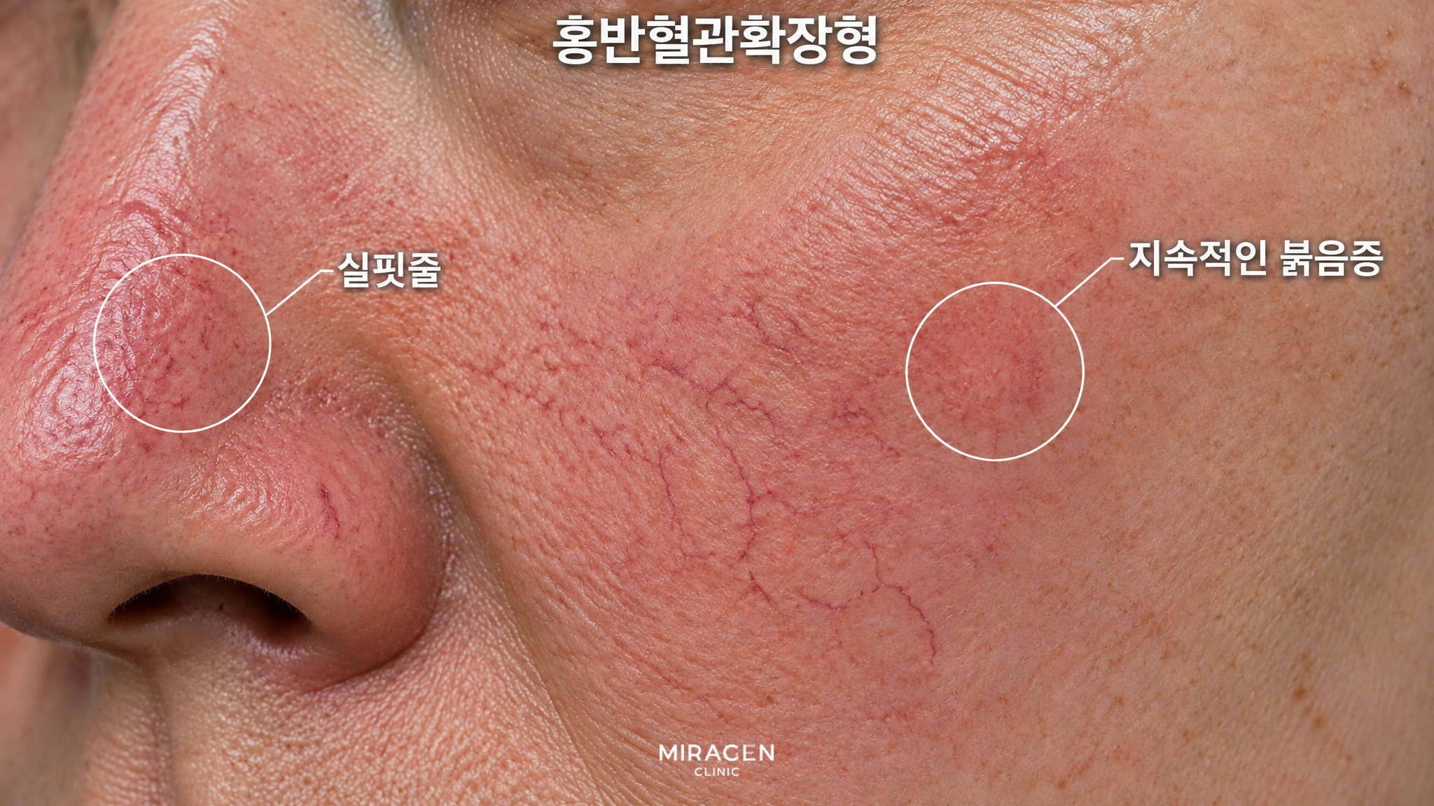 홍반혈관확장형: 코 옆과 뺨이 붉고 가는 실핏줄이 보이는 피부 확대 사진