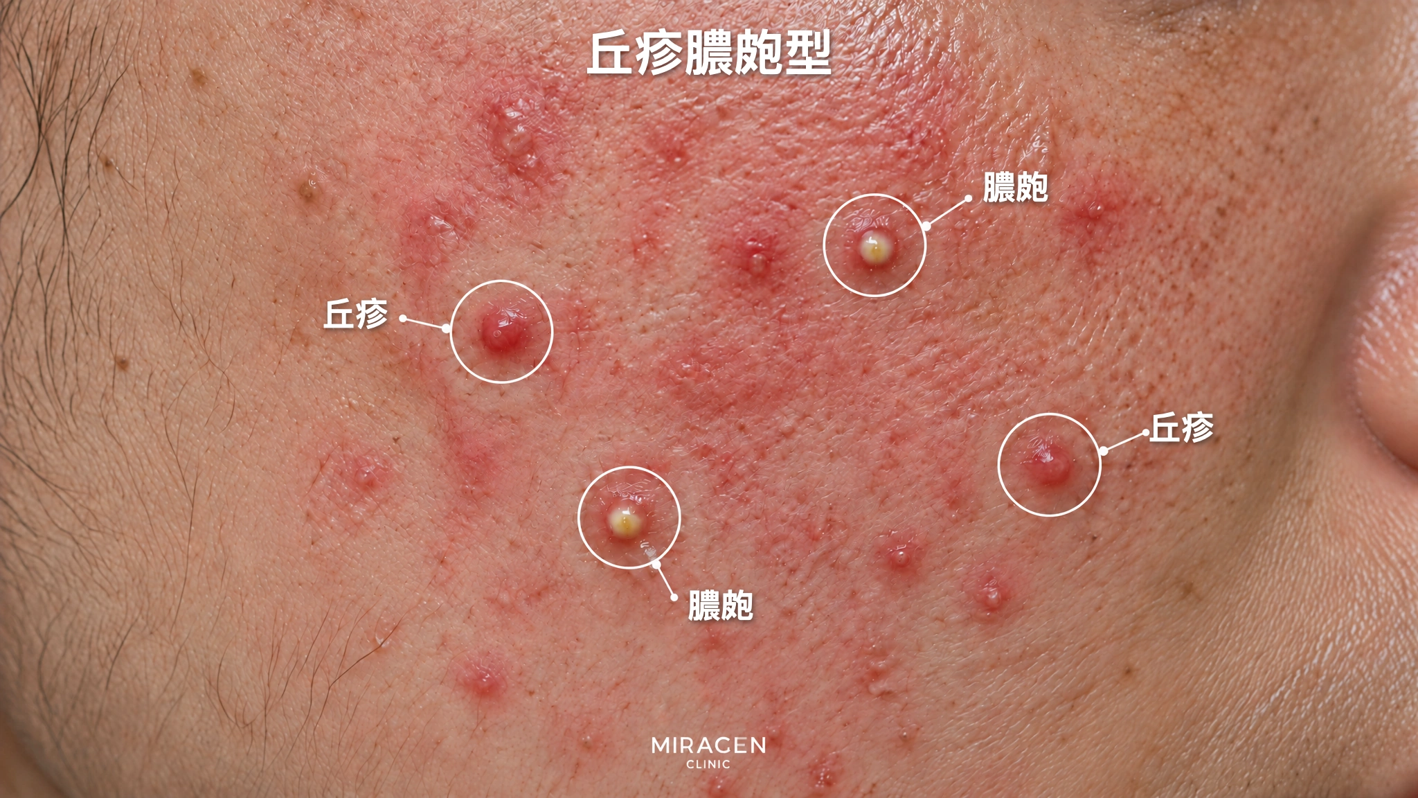 丘疹膿皰型：泛紅的臉頰上散布著紅色凸起，以及積有黃色膿液的凸起的皮膚放大照片