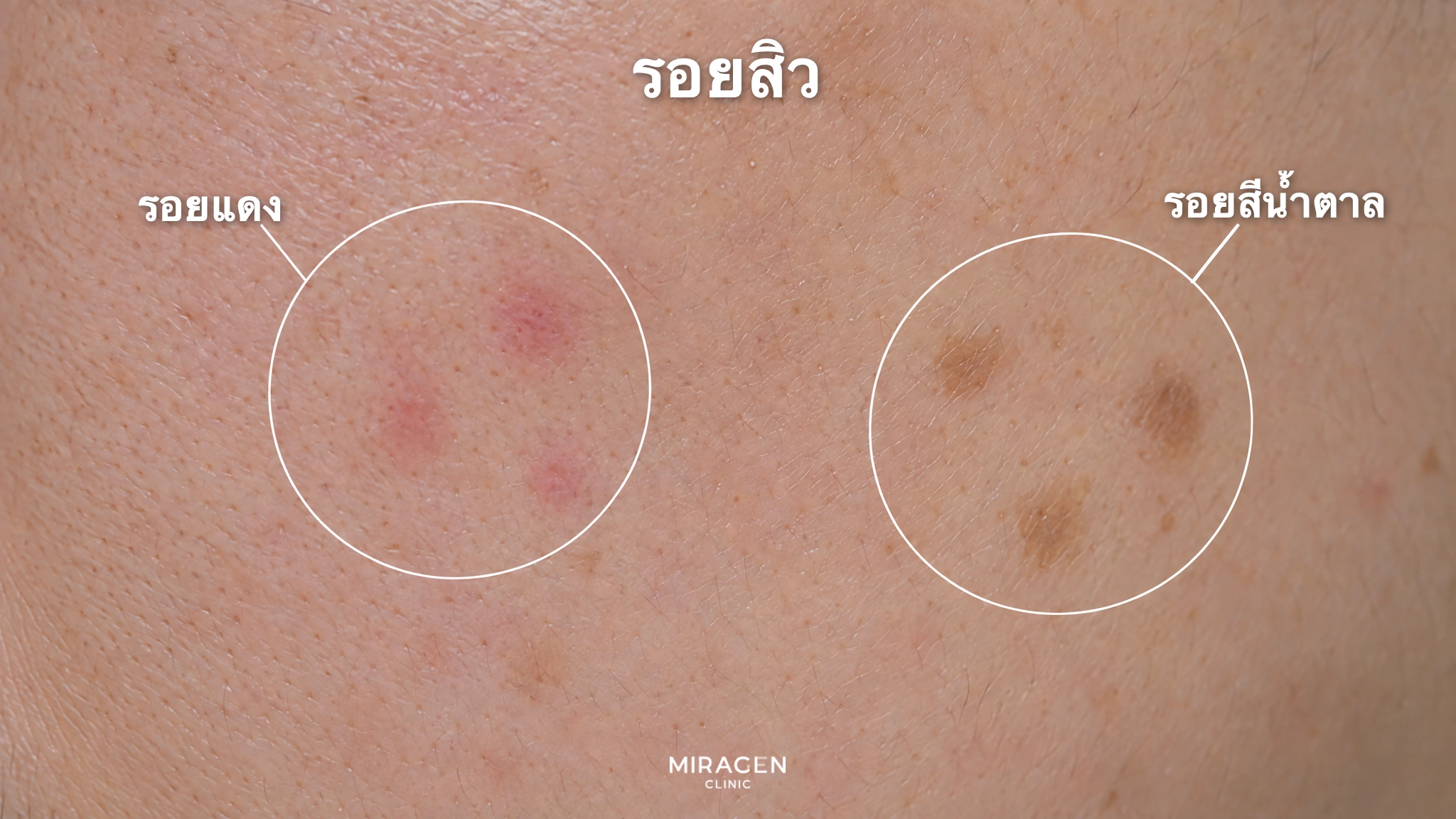 ภาพขยายผิวแก้มที่วงกลมแสดงรอยแดงและรอยน้ำตาลที่เรียบไปกับผิว