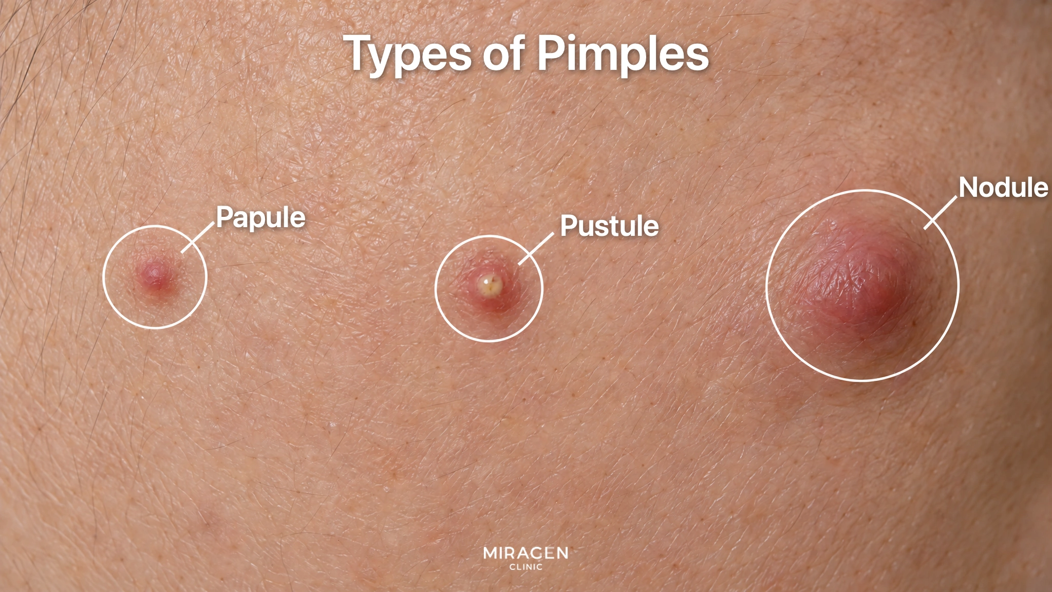 A magnified view of cheek skin with circles marking a small raised red papule, a pustule showing yellow pus, and a large, deep, swollen nodule